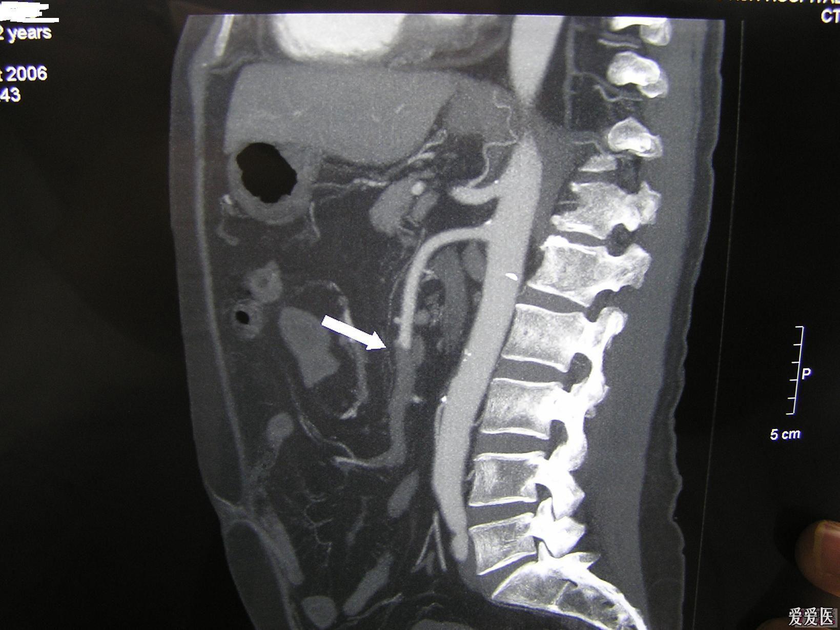 急腹症肠系膜上动脉栓塞smae误诊分析请进