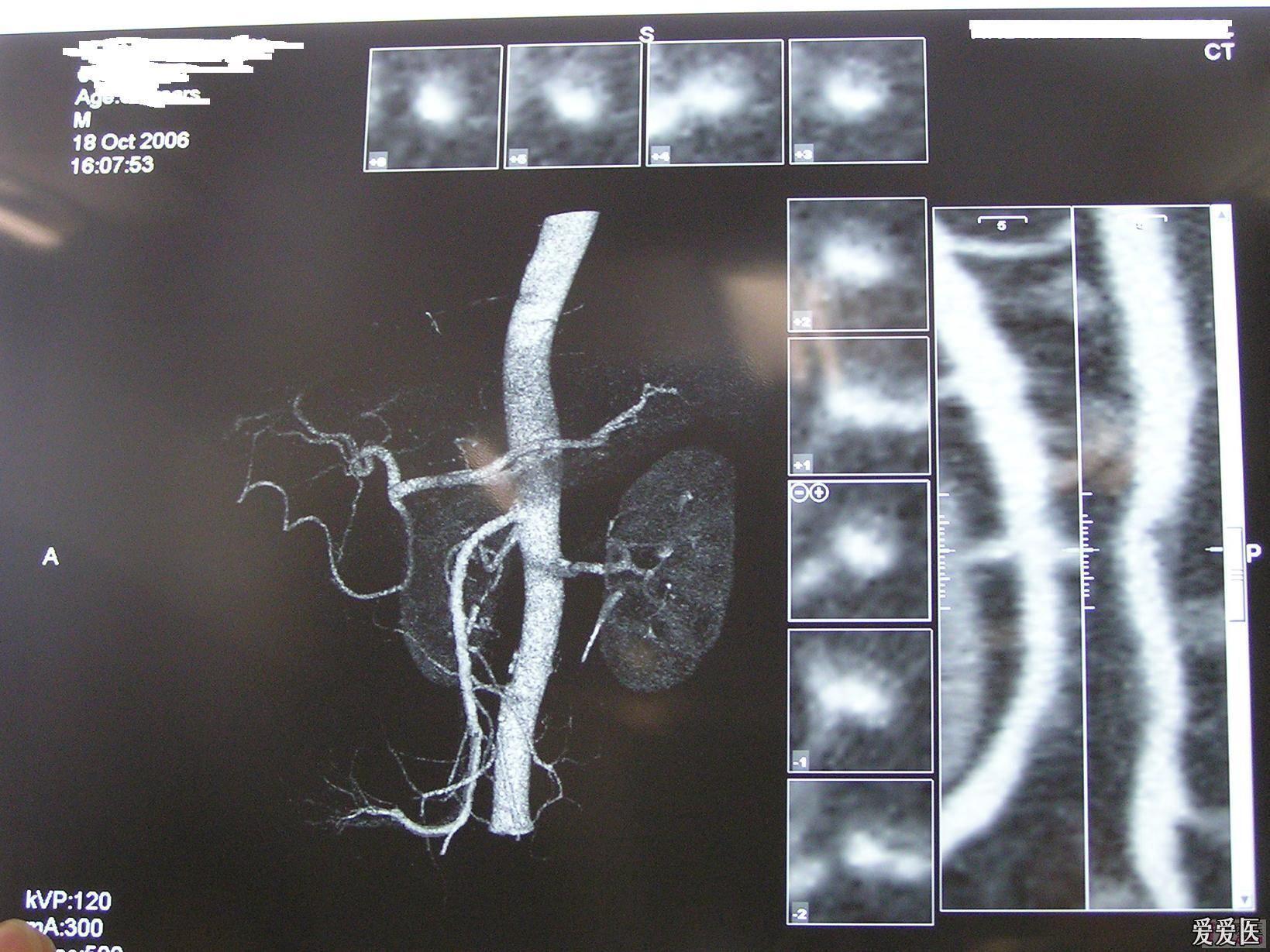 急腹症肠系膜上动脉栓塞smae误诊分析请进