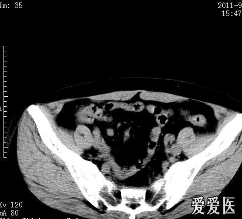 女性盆腔静脉石图片
