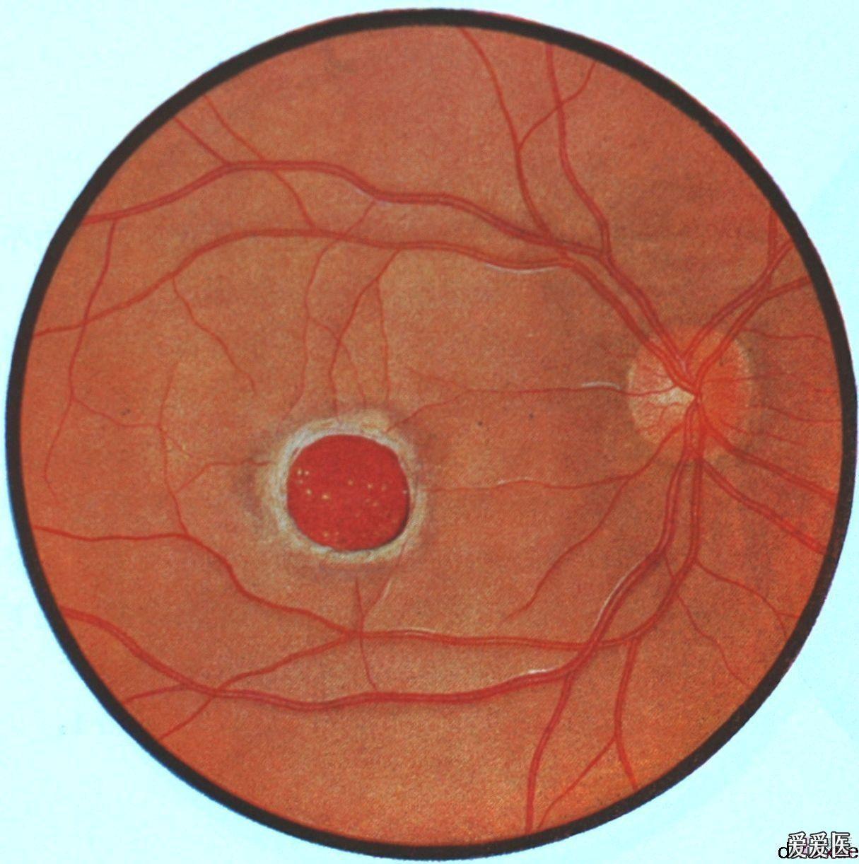 2.右眼外伤黄斑裂孔.jpg