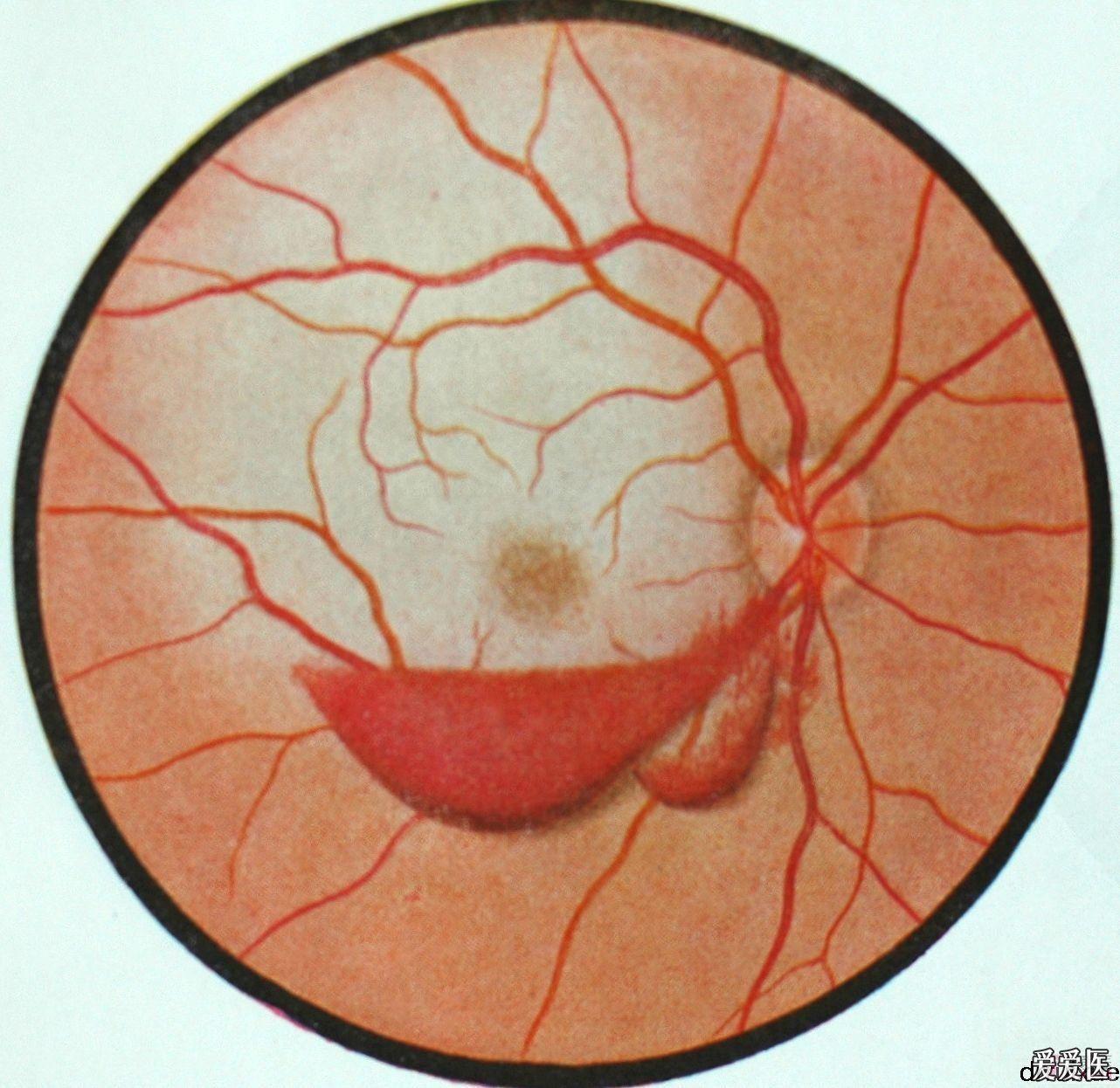 虹膜出血图片
