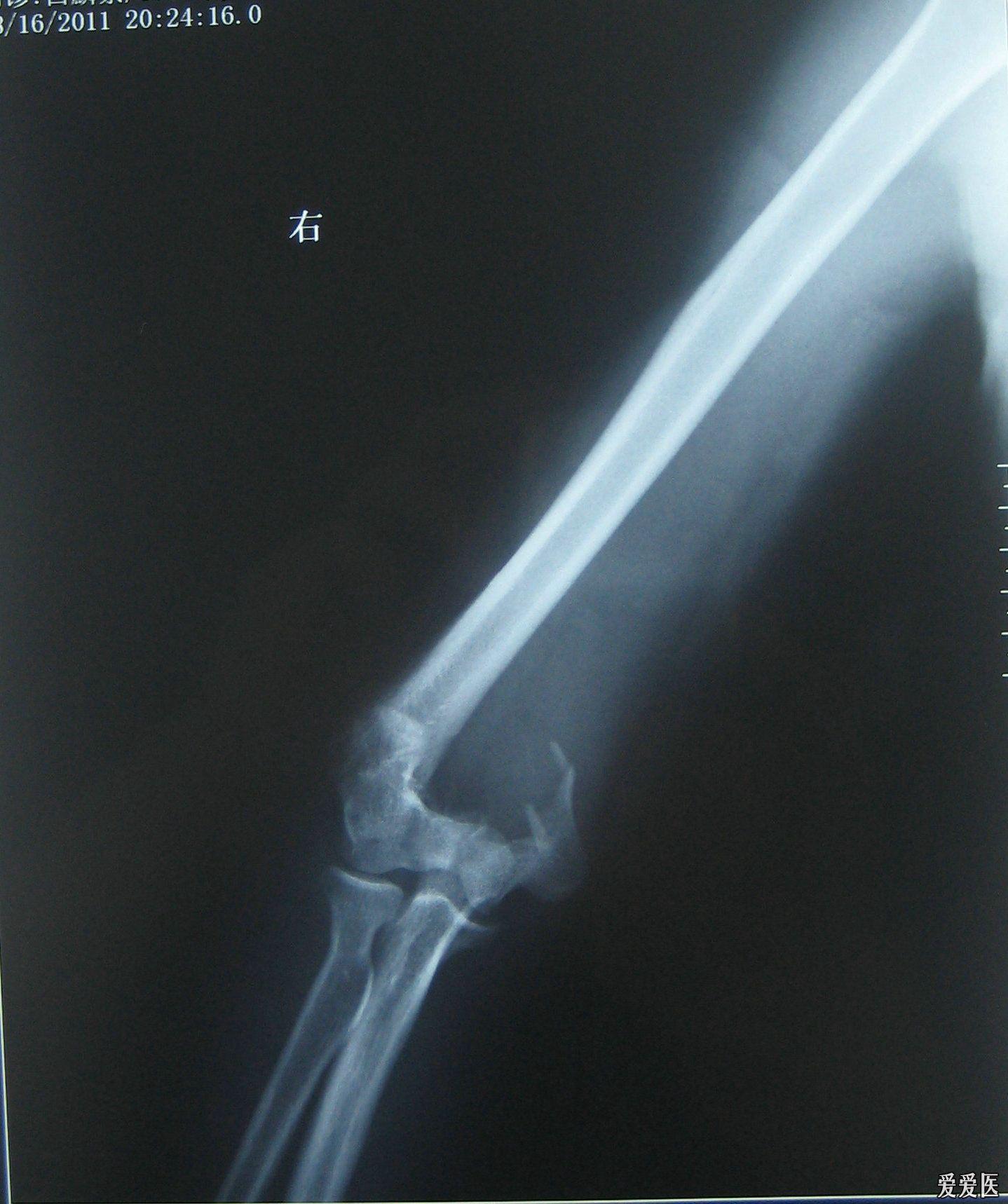 69 右肱骨髁上,髁间粉碎性骨折   右肘关节正位片