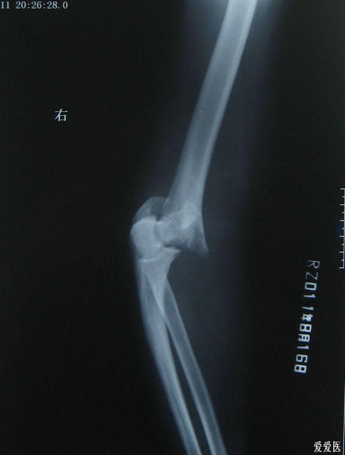 69 右肱骨髁上,髁间粉碎性骨折   右肘关节正位片   右肘关节侧位片