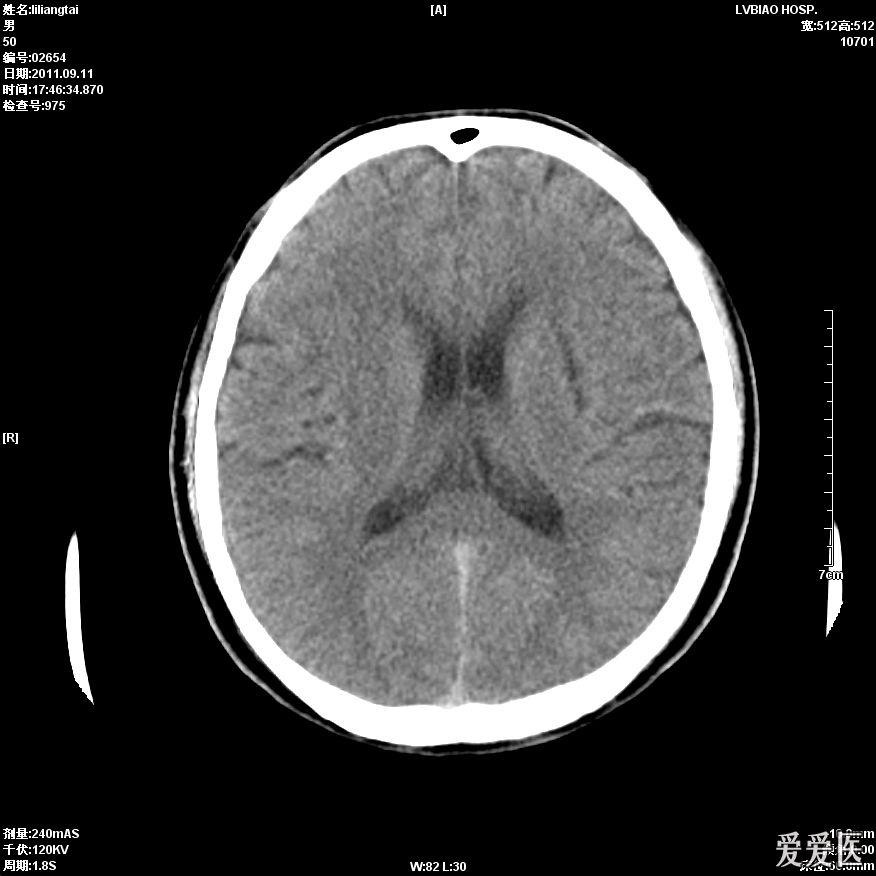 头部ct照片图片