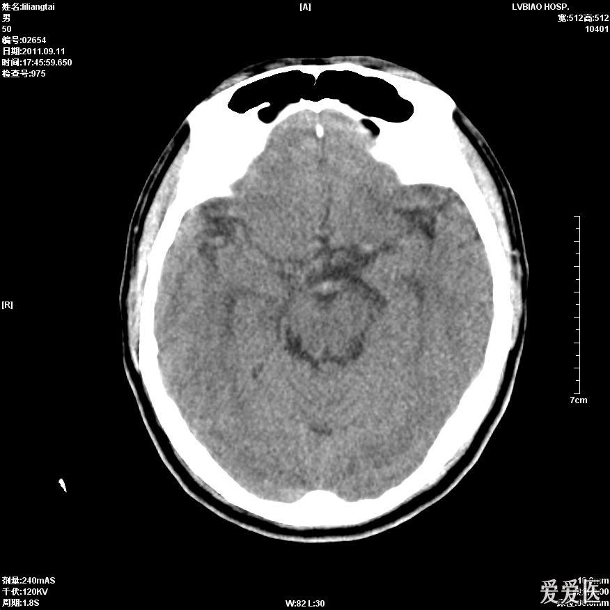 头颅ct平扫大脑中动脉密度增高两例