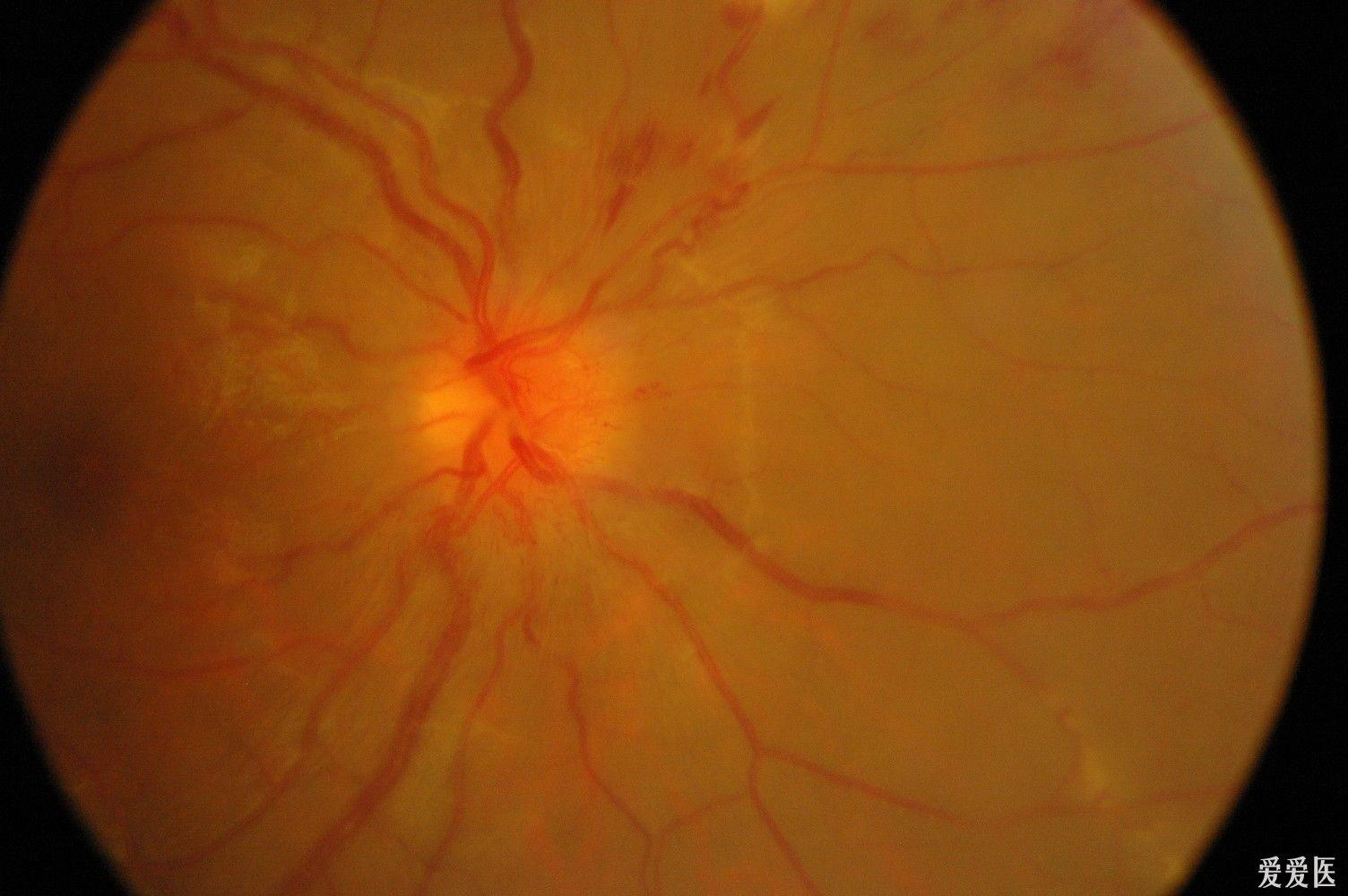 是视网膜血管炎吗