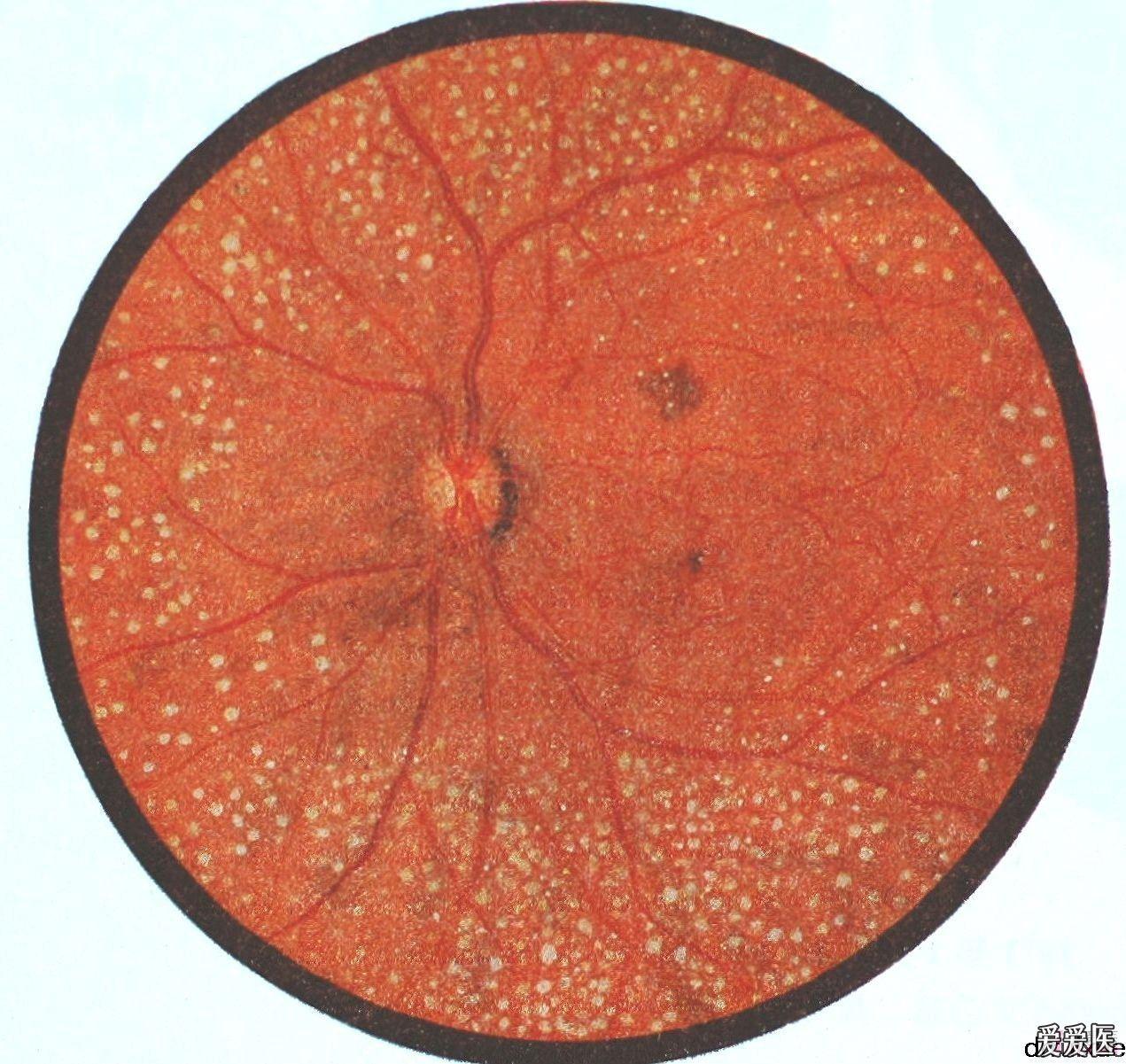 經典眼底病彩色圖譜持續更新希望大家關注