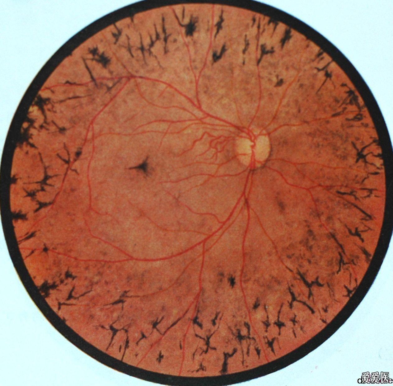 经典眼底病彩色图谱持续更新希望大家关注