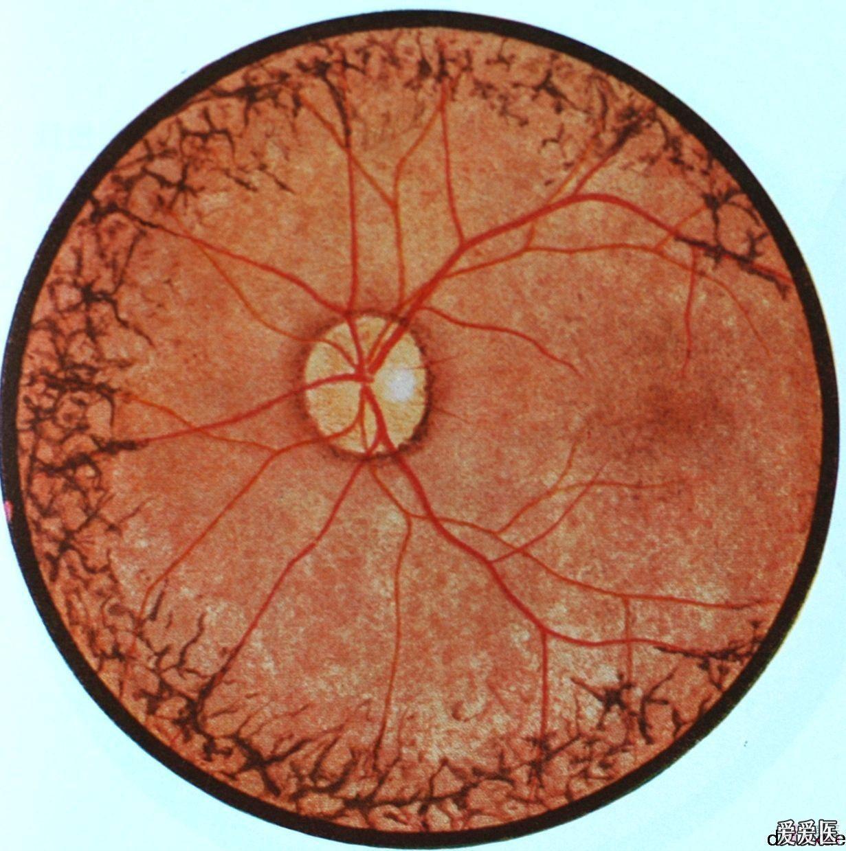经典眼底病彩色图谱持续更新希望大家关注