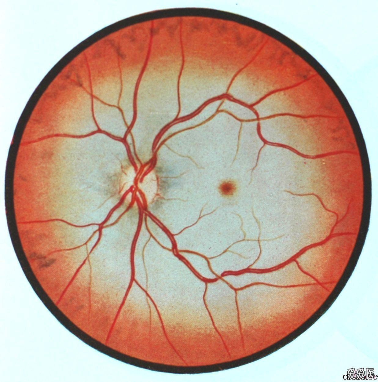 经典眼底病彩色图谱持续更新希望大家关注