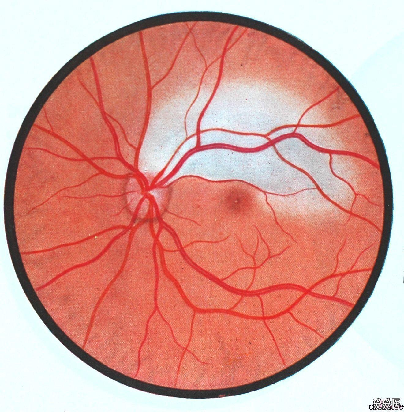 经典眼底病彩色图谱