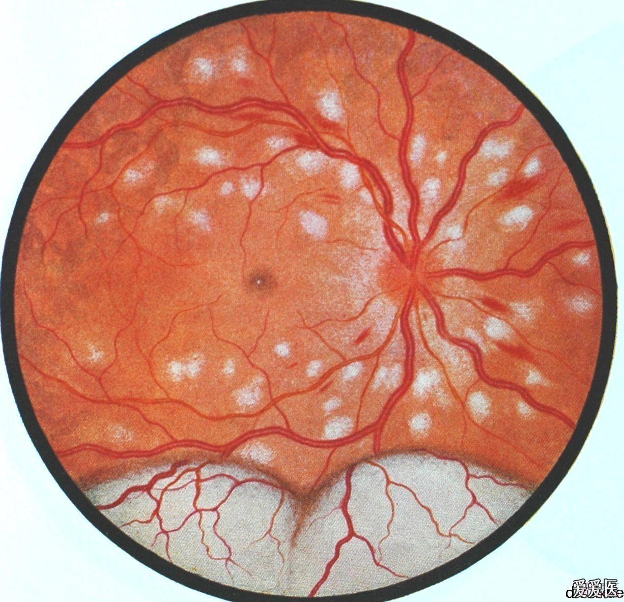 经典眼底病彩色图谱持续更新希望大家关注