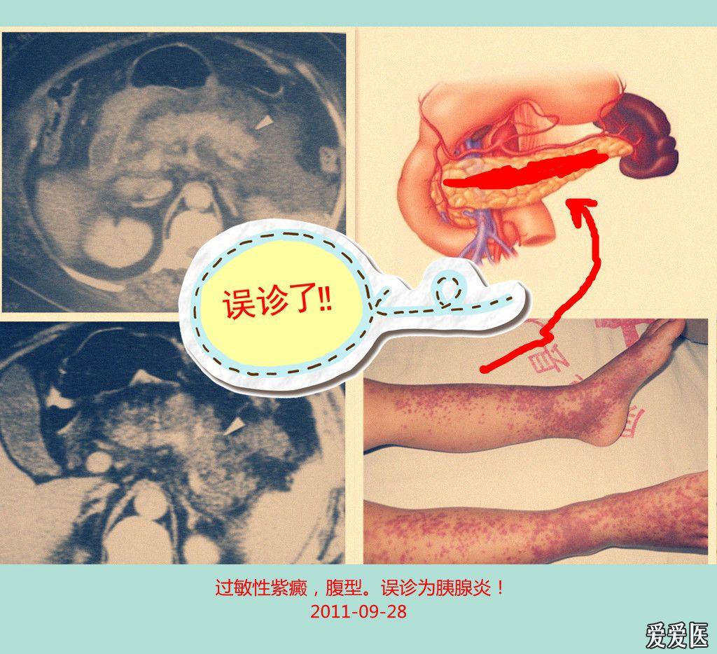 失敗中尋求經驗:腹型過敏性紫癜誤診為急性胰腺炎