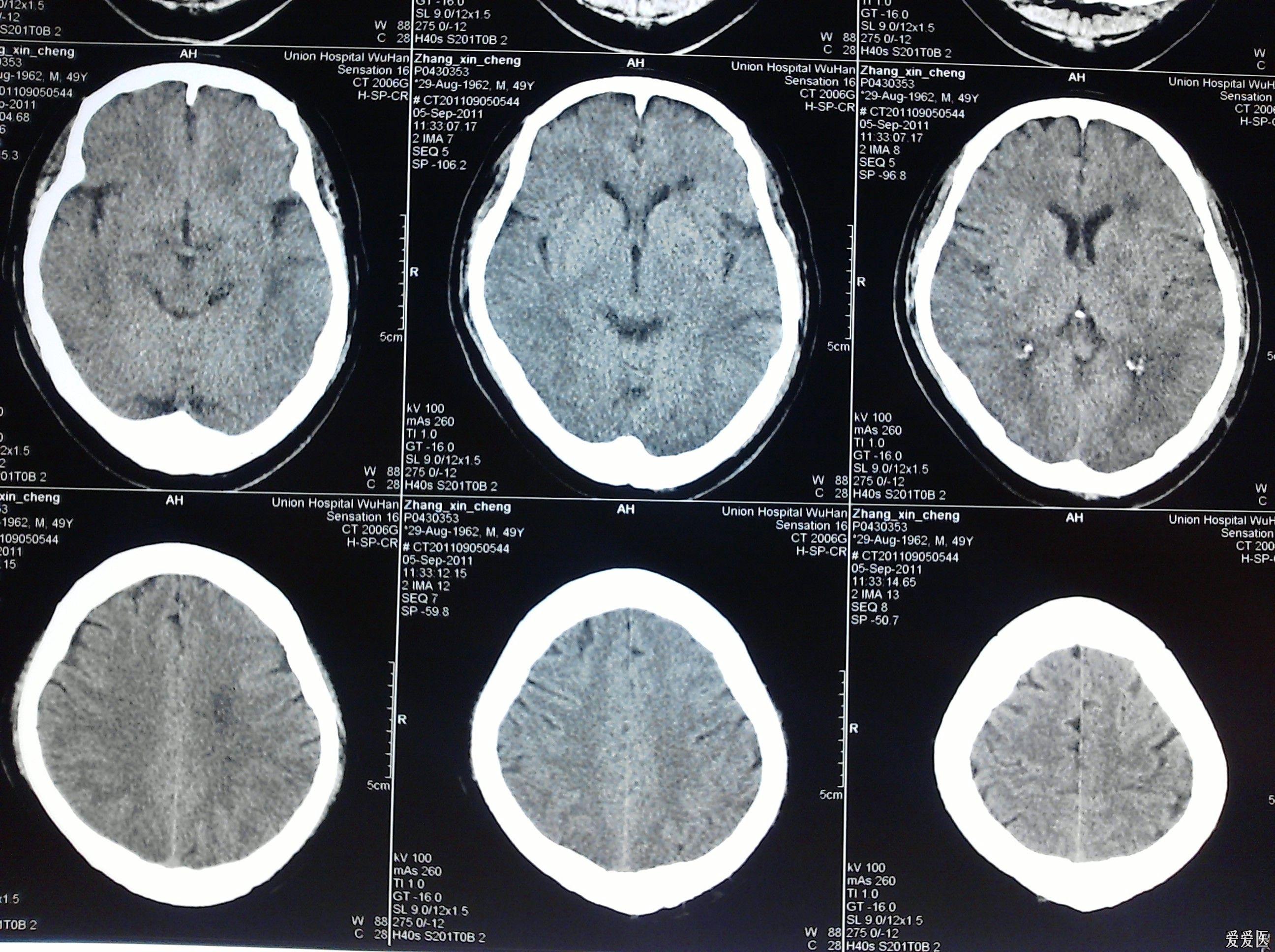 失語伴右側肢體乏力半月餘,顱腦ct,mri,mra - 醫學影像學討論版