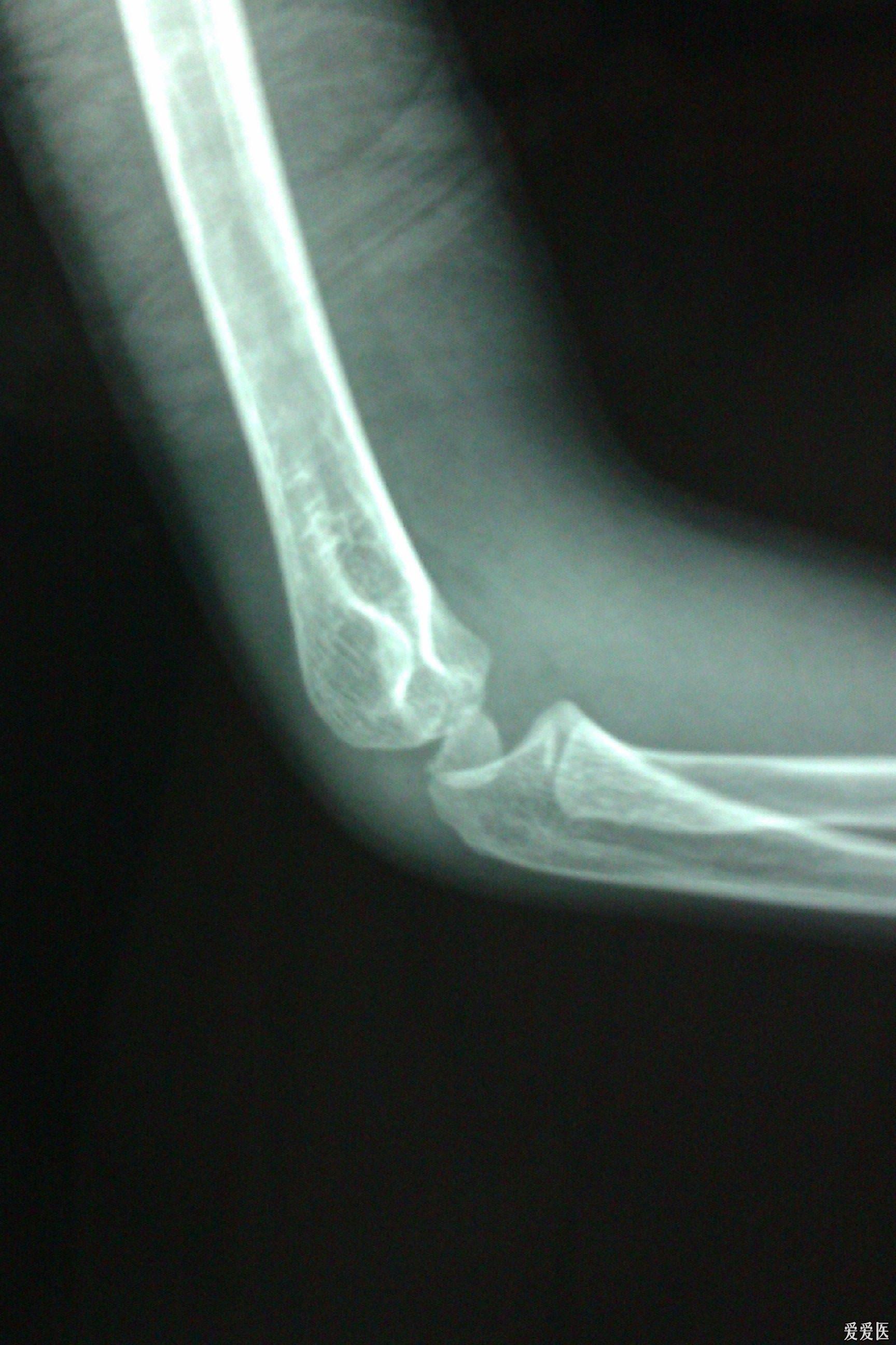4岁儿童肘关节x片图片