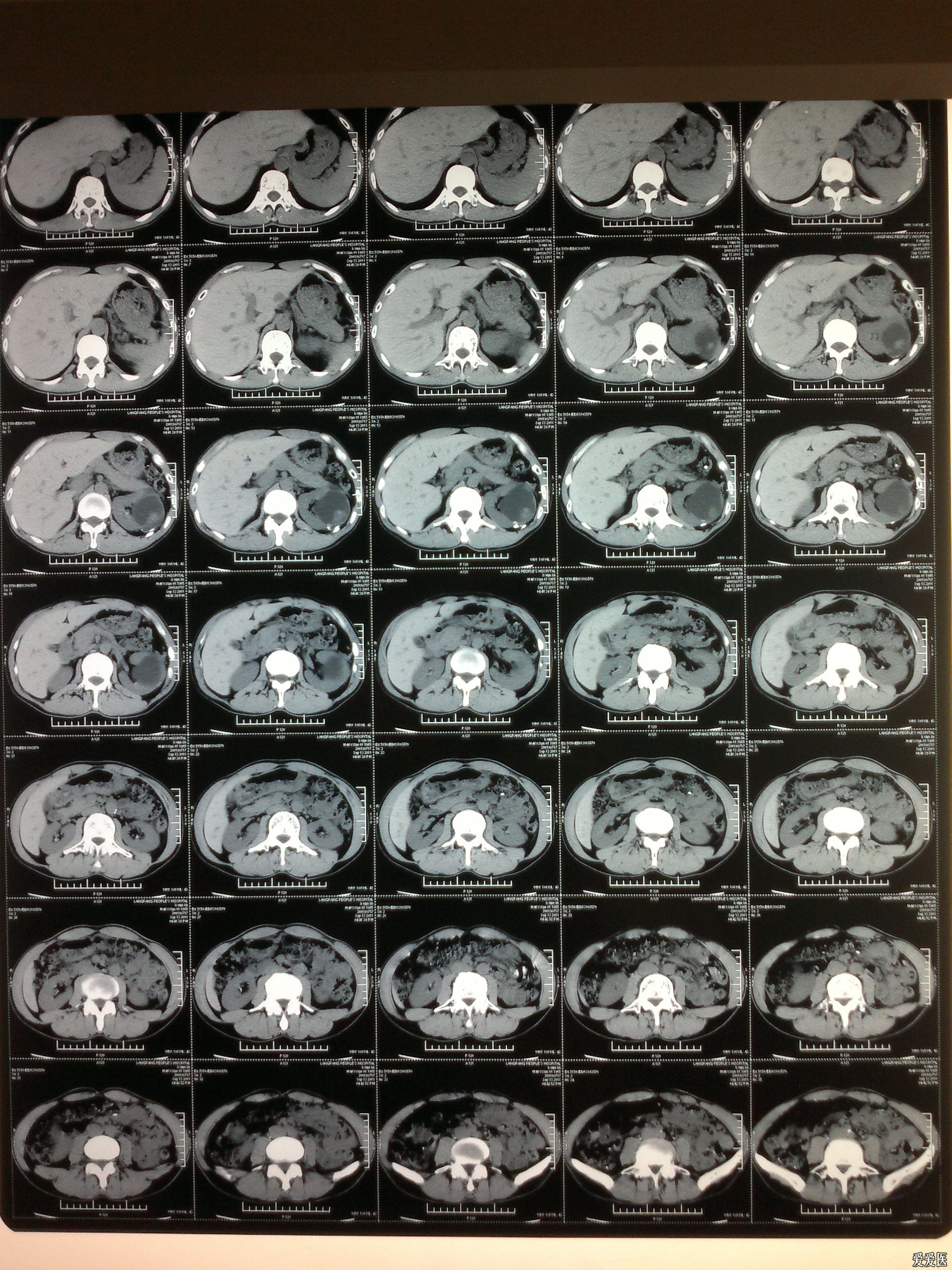 肾挫伤保守一个月结果
