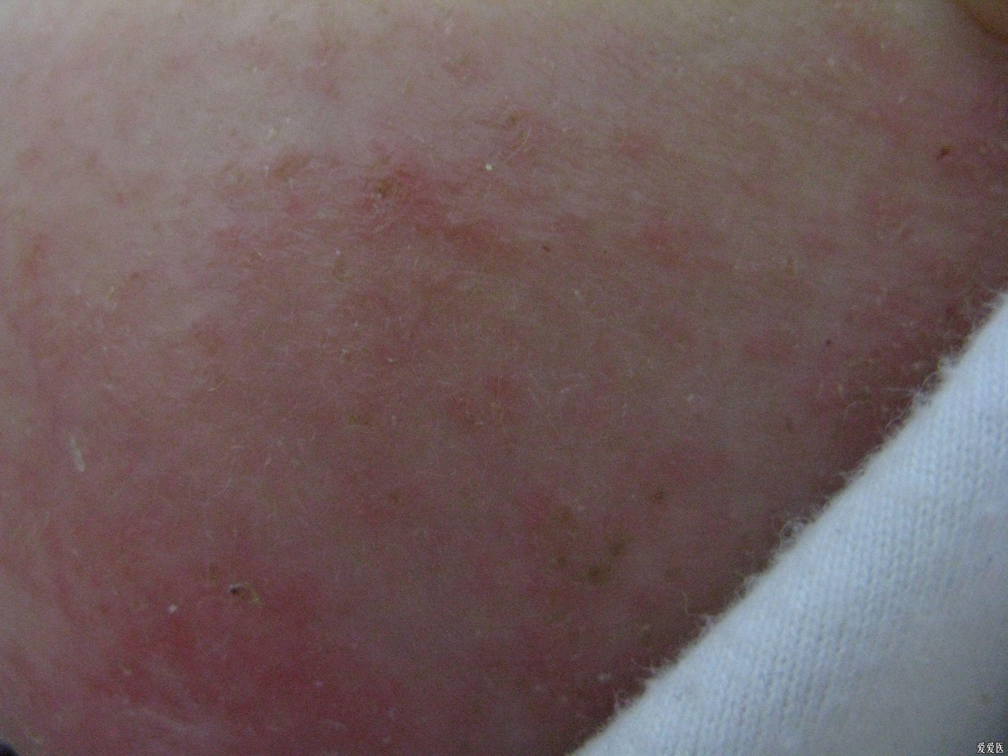 我儿子身上不停地起疹子望高诊