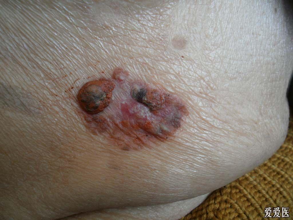 有奖猜答29公布答案bowen病39人回答准确均加分