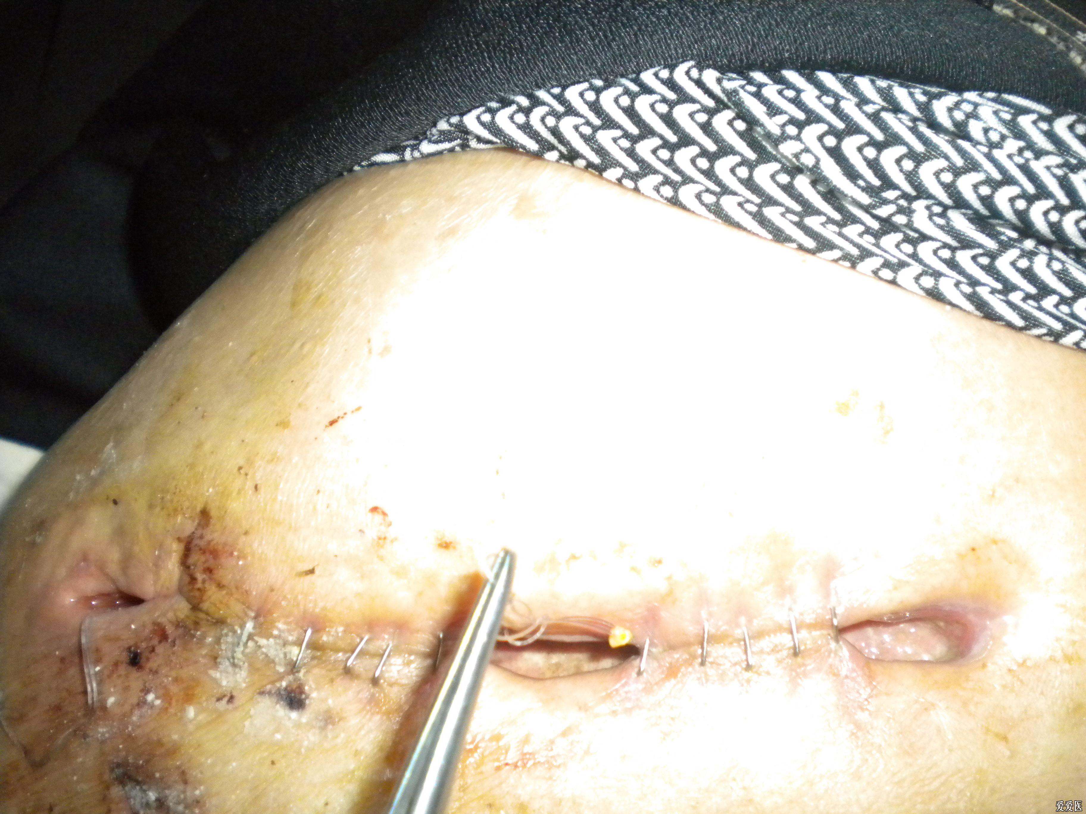 术后伤口脂肪液化图片图片