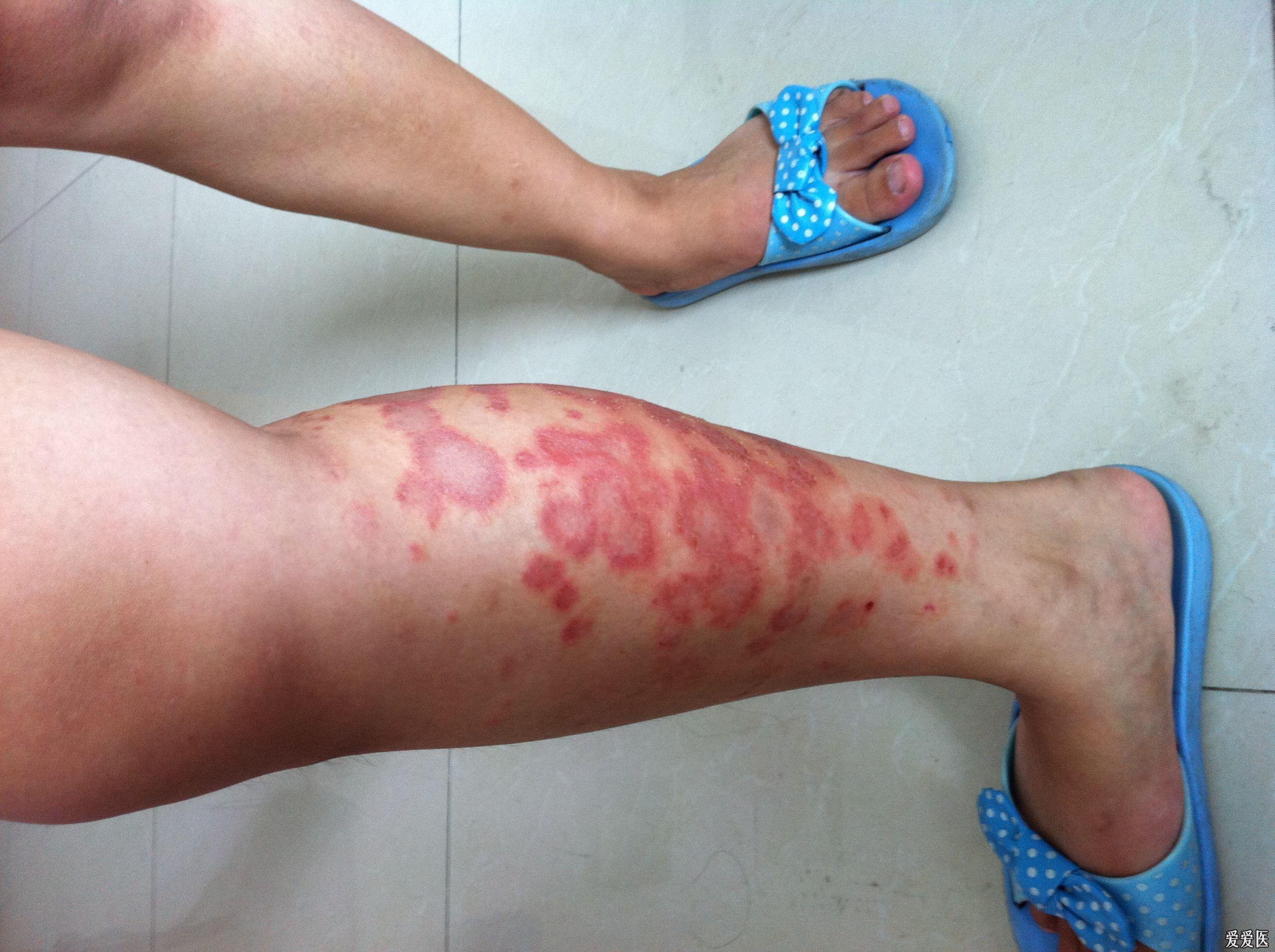 10月11日门诊病案右下肢皮疹10月16日更新
