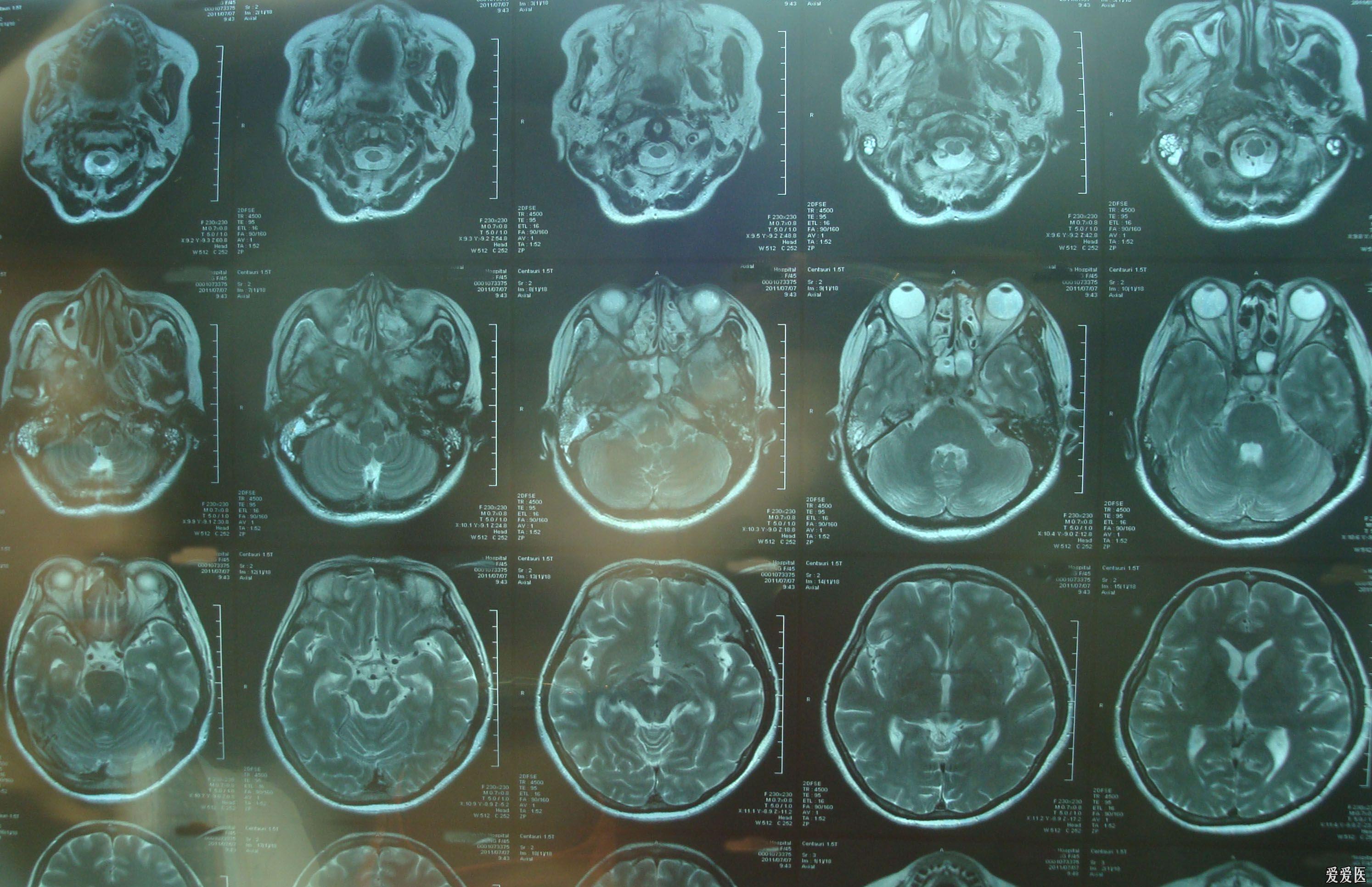 病例讨论鼻咽癌