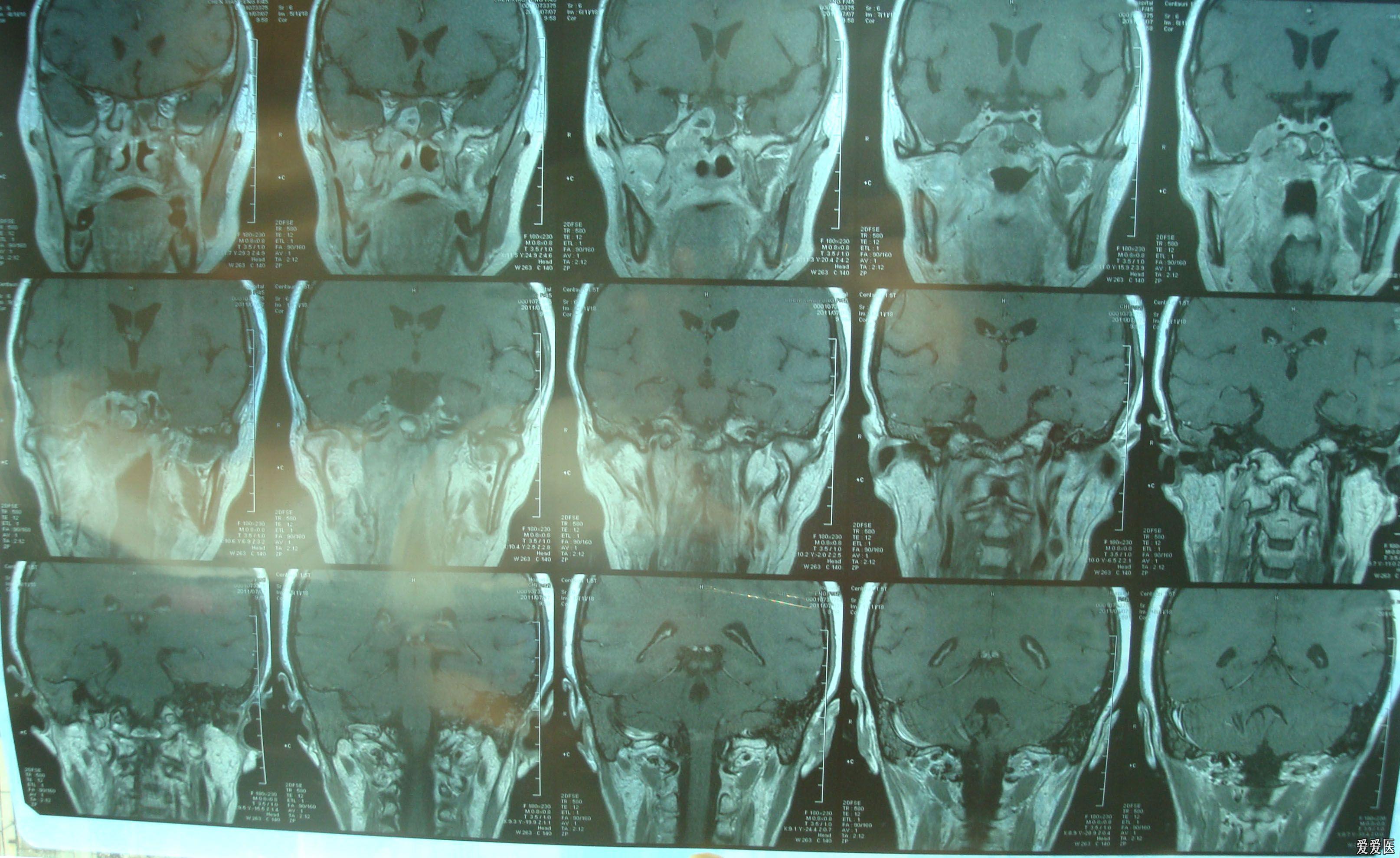 病例讨论鼻咽癌