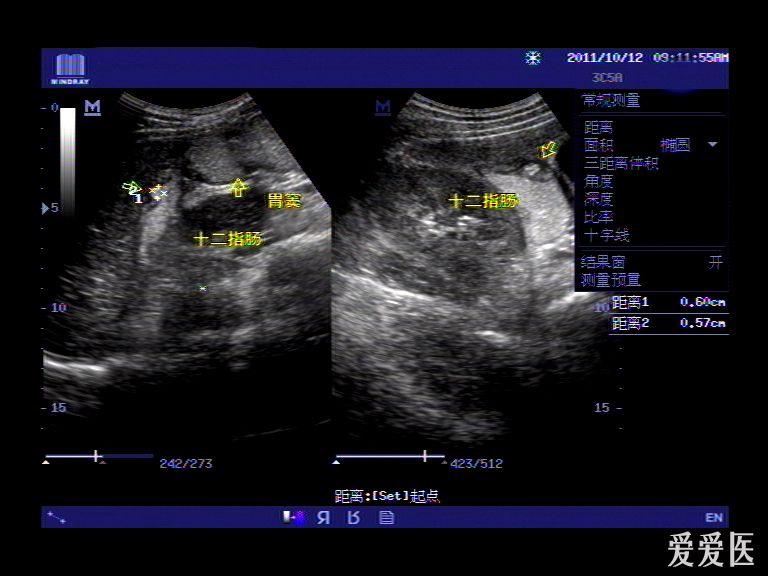 胃腸超聲典型病例之十十二指腸球部潰瘍