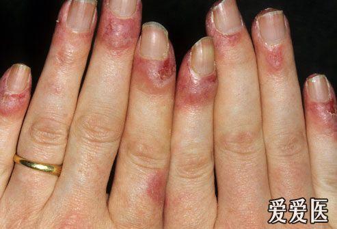 图解系统性红斑狼疮专贴,精彩绝伦!继续编辑中