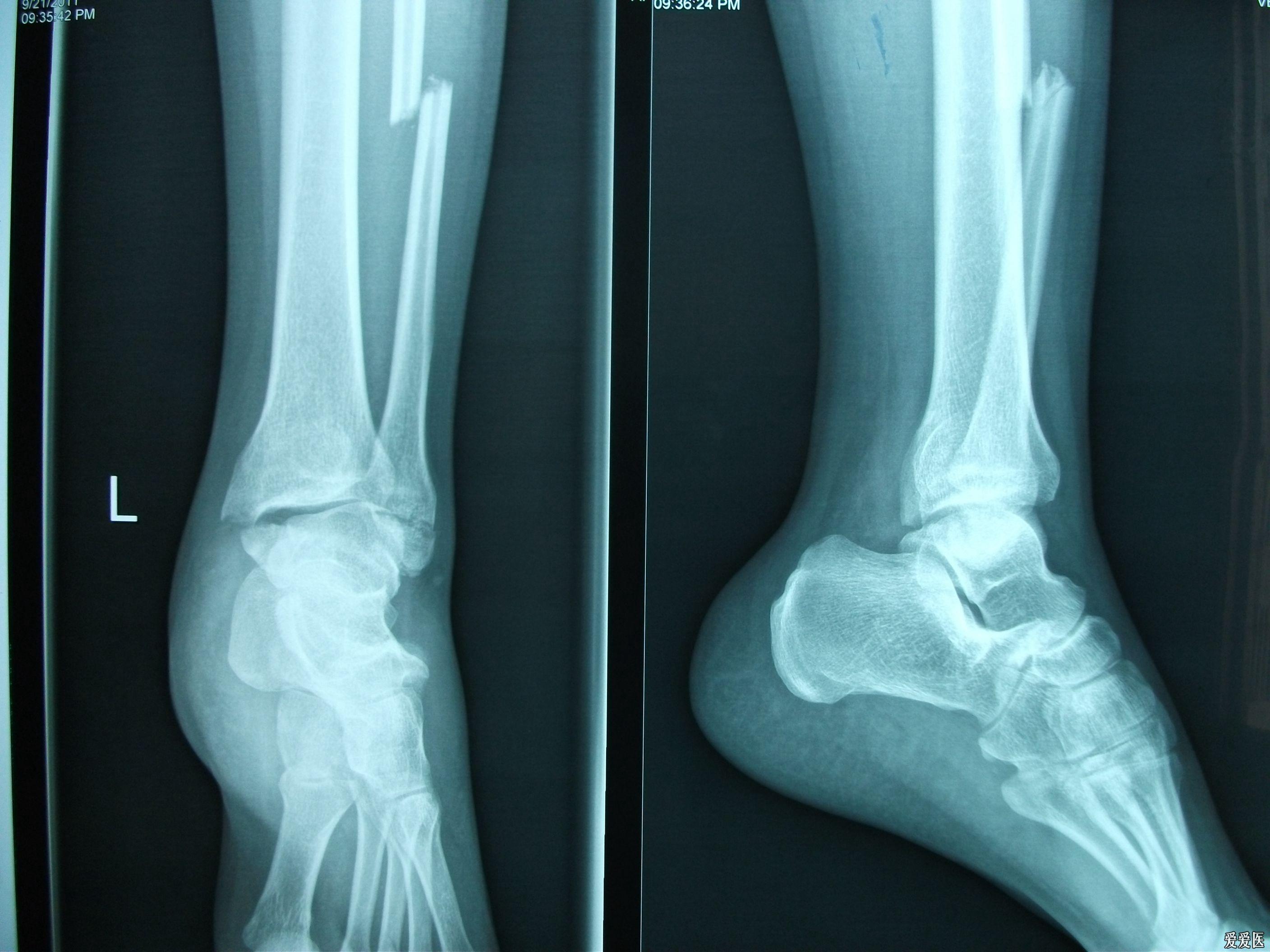 踝关节骨折x光片图片