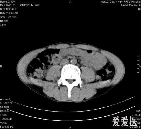 双肾病变