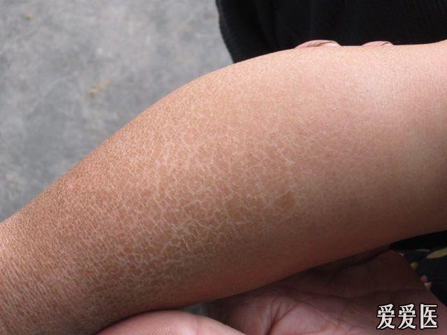 各位爱友看图后给点指导 - 皮肤及性传播疾病讨论版 - 爱爱医医学论坛