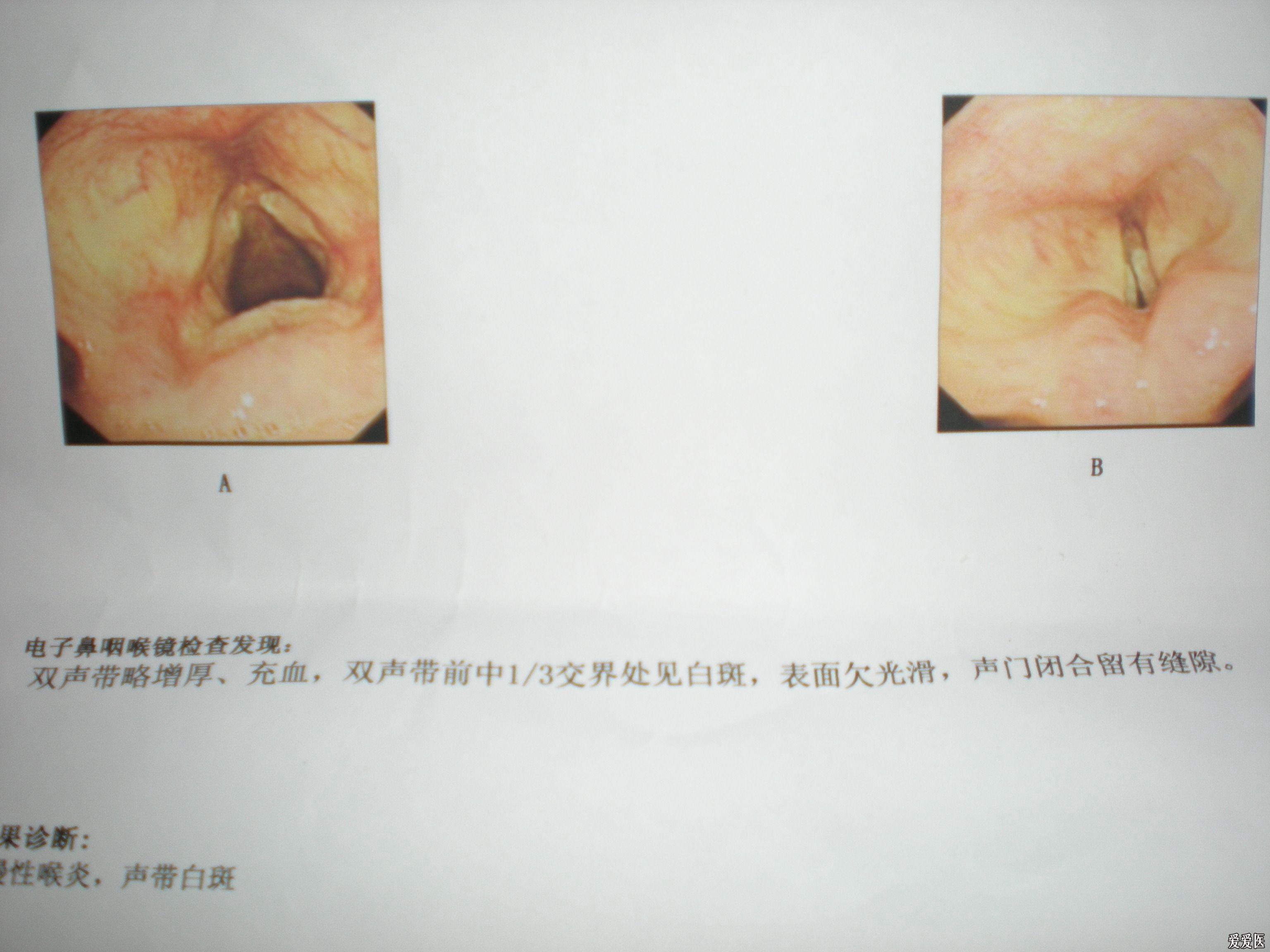 慢性咽喉炎图片喉镜图片