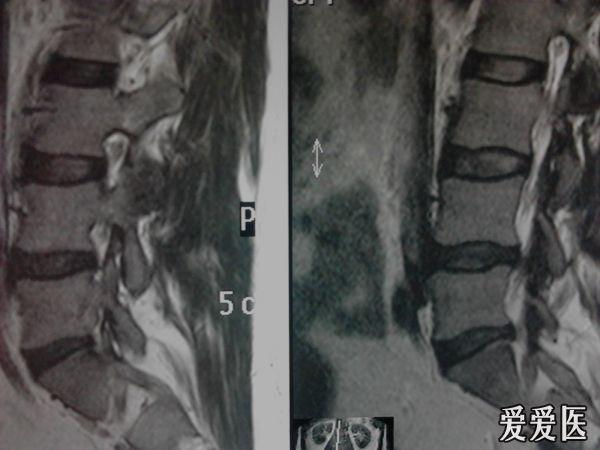 腰椎间盘突出症是否内固定，腰5-骶1是否手术？