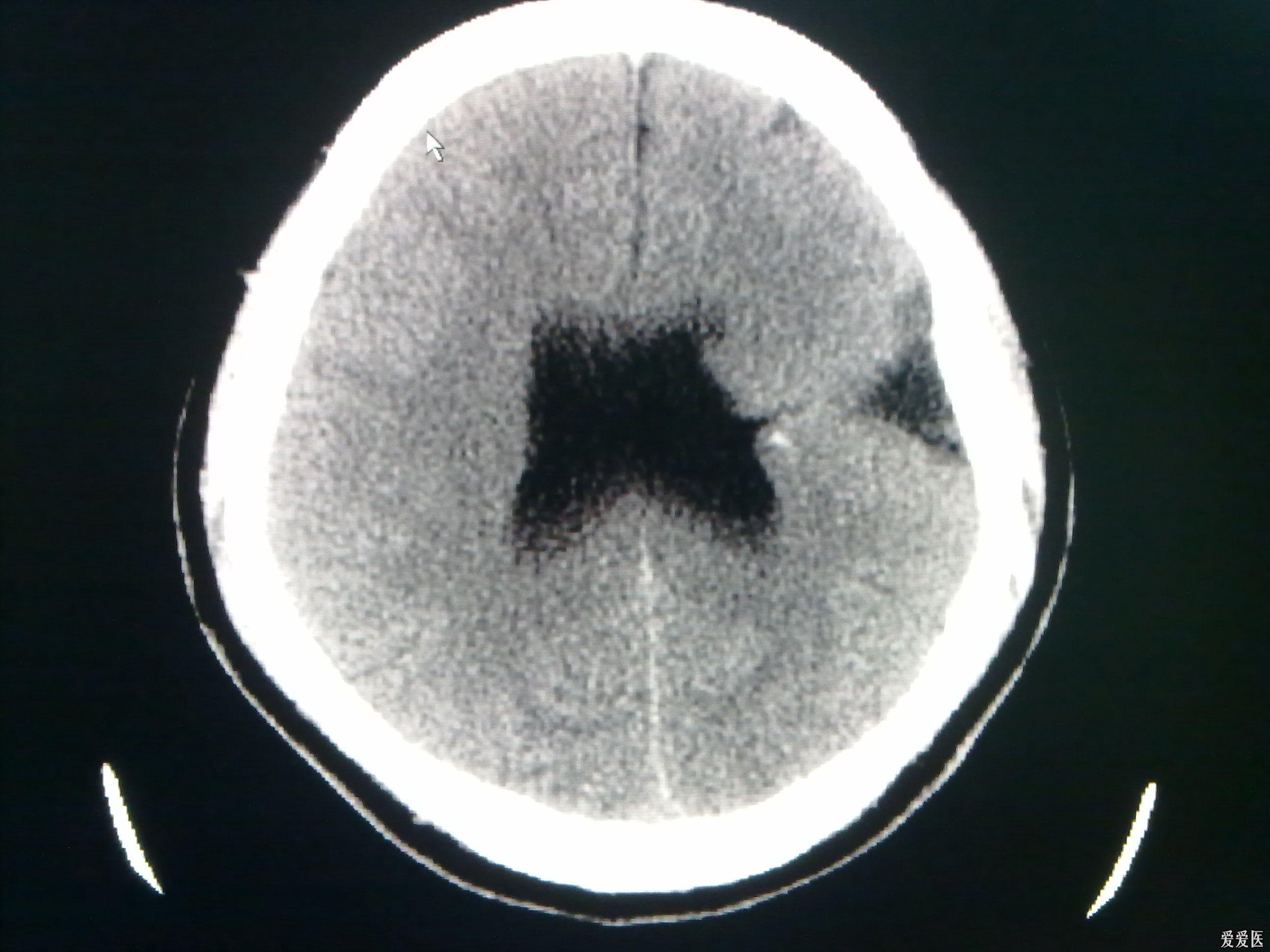 今天做到的病例脑裂畸形