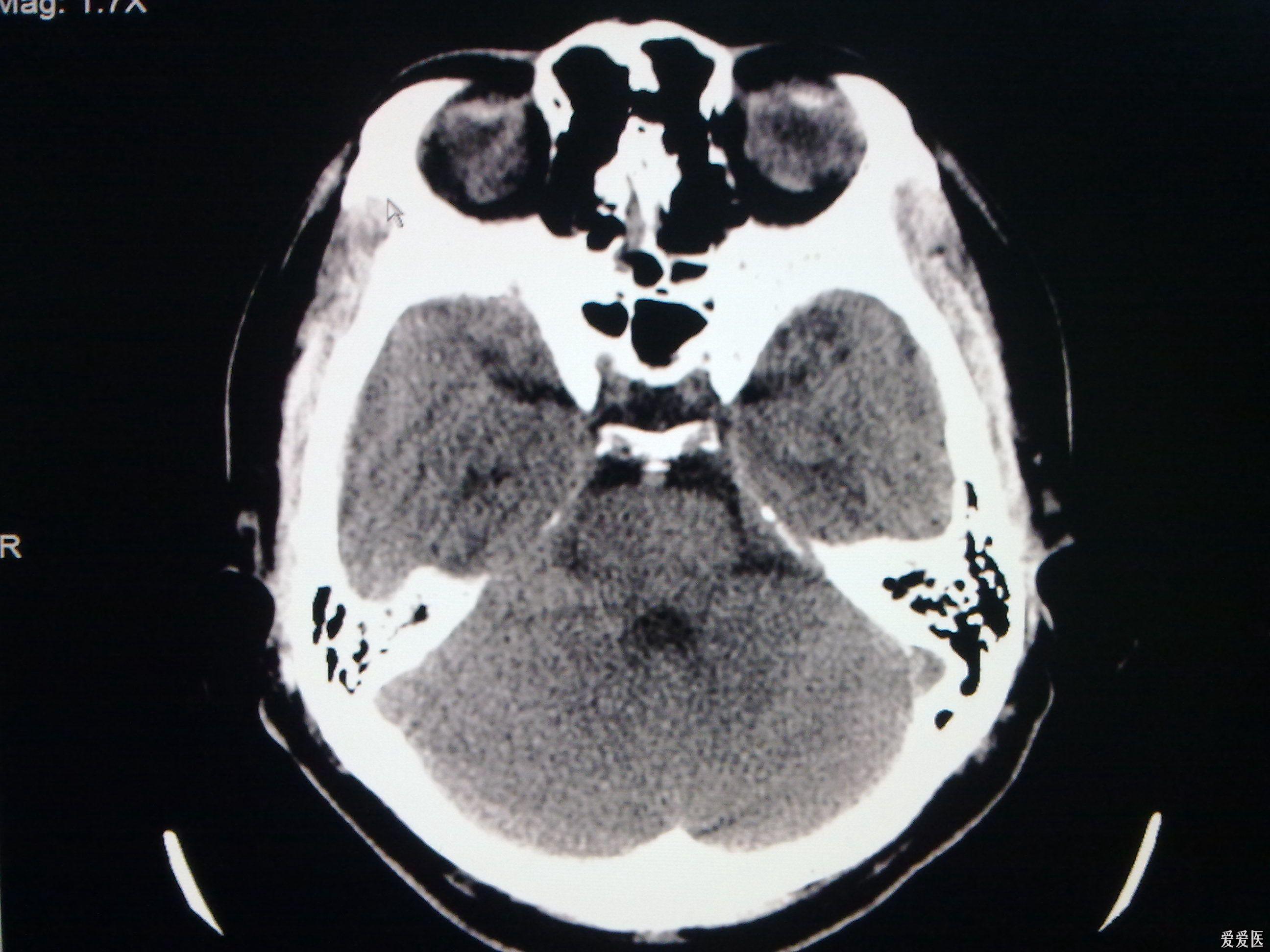 今天做到的病例脑裂畸形