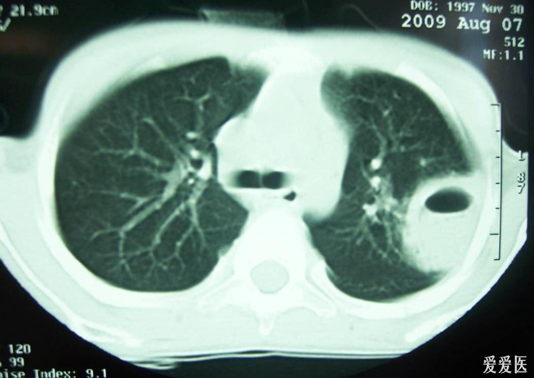 [看图说话]3张x线片诊断(肺脓肿)