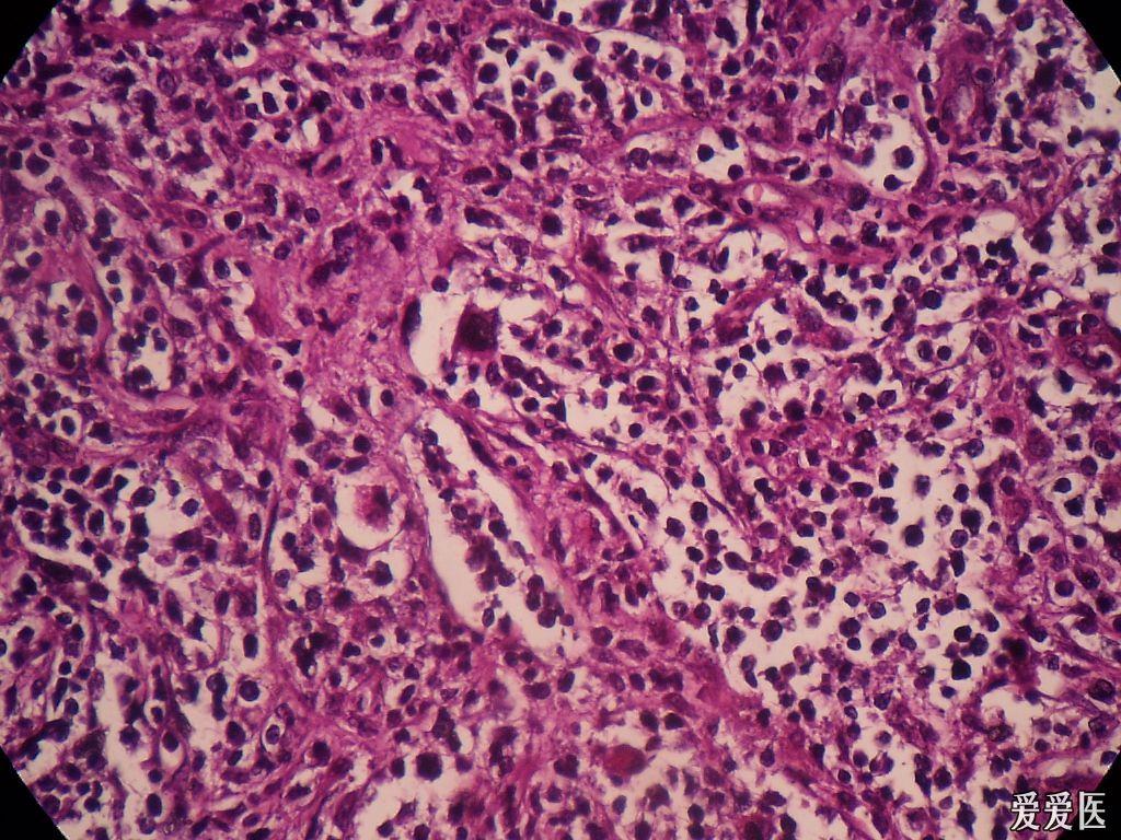 非霍奇金淋巴瘤吗? 求助!