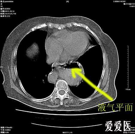 老年女性胸腔胃一例
