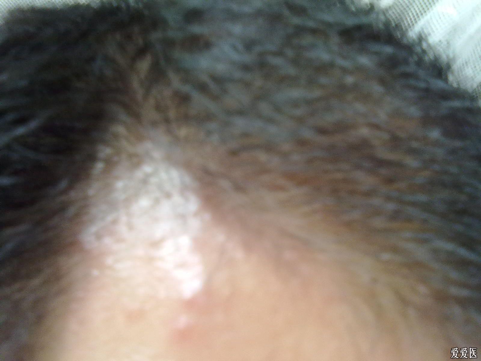 求助头面部出现瘙痒性丘疹有图