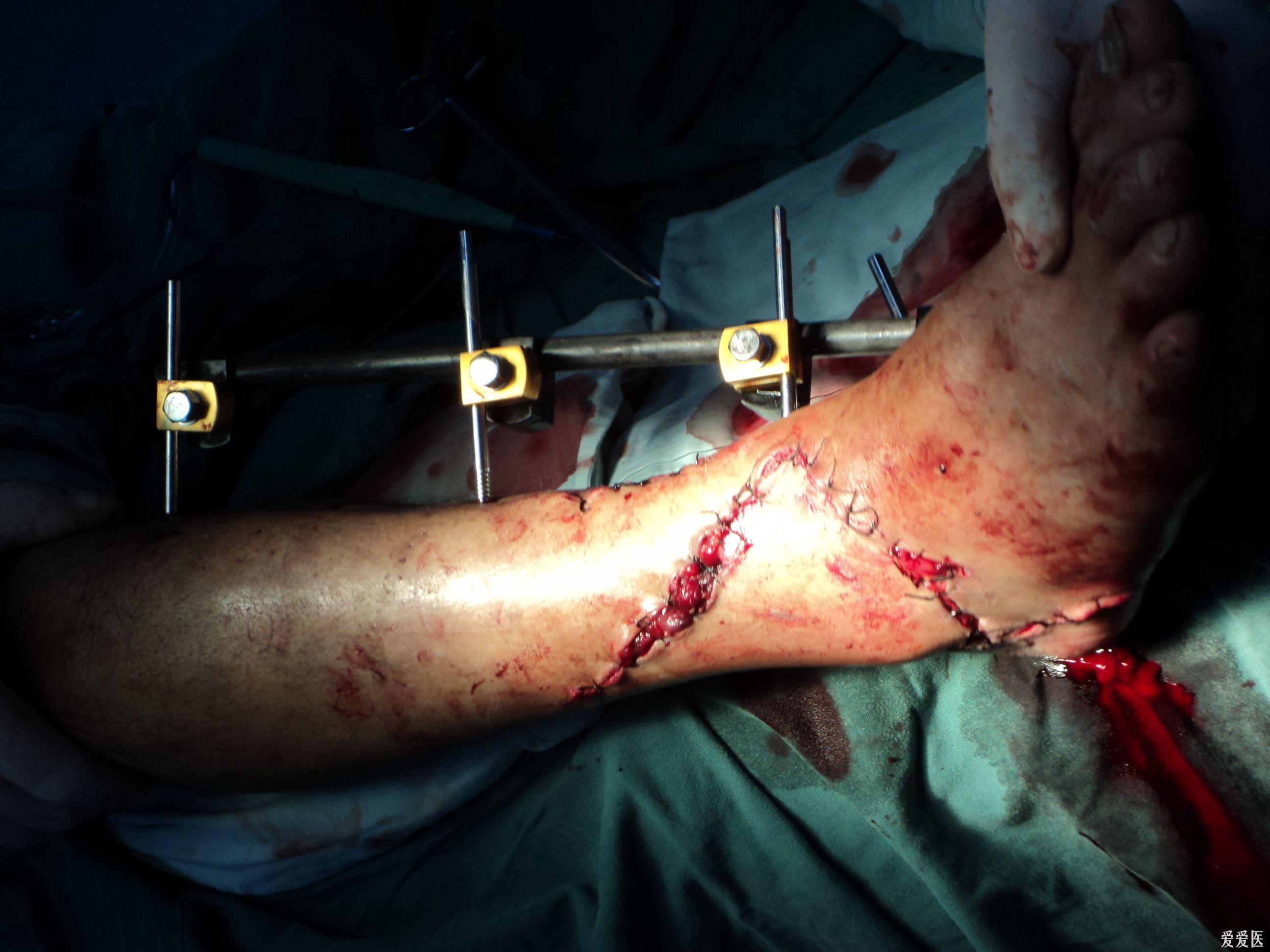右胫腓骨下段粉碎性开放性骨折 - 骨科与显微外科专业讨论版 - 爱爱医