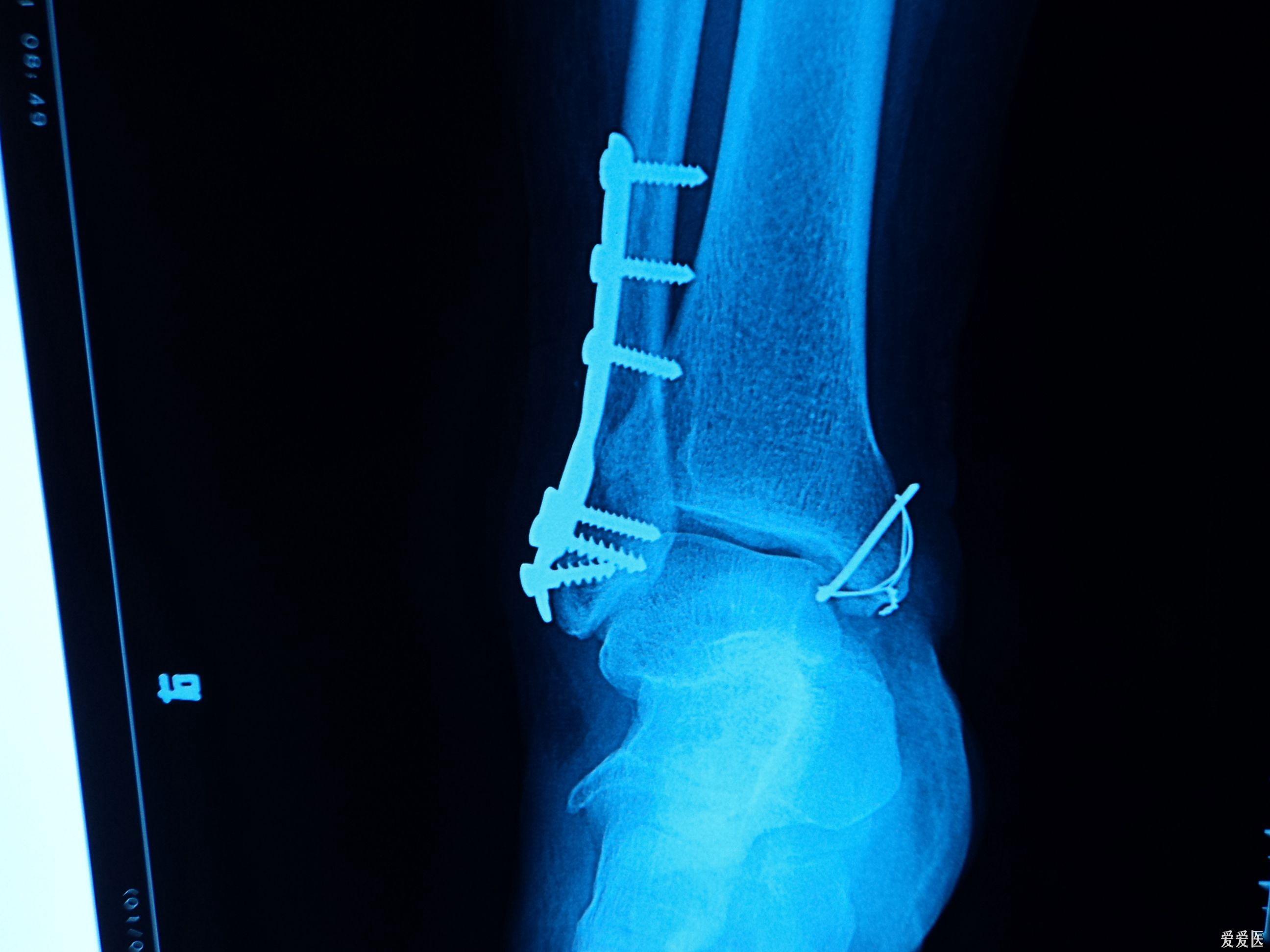 内外踝骨折术后