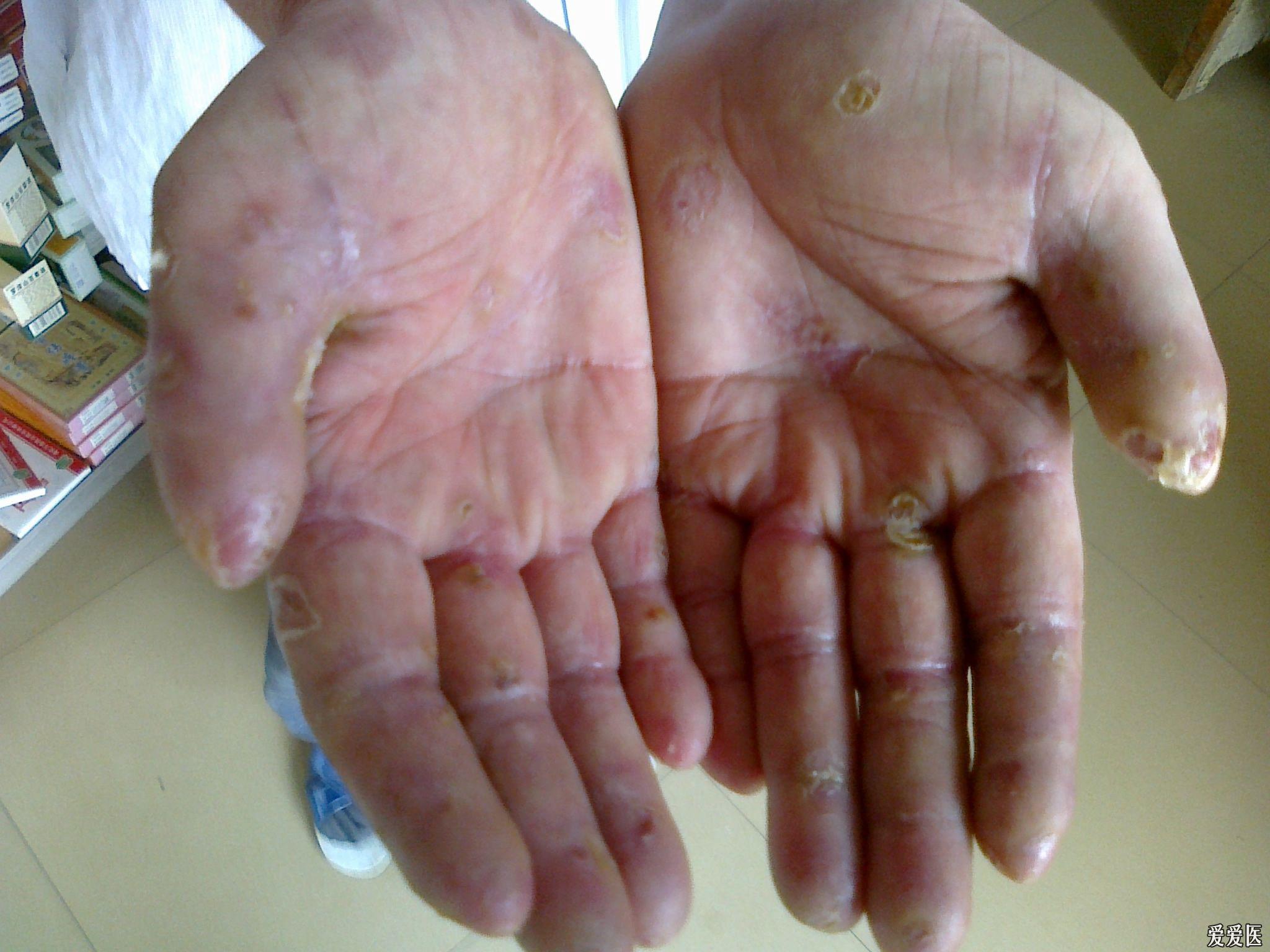 皮肤病痛苦40余年