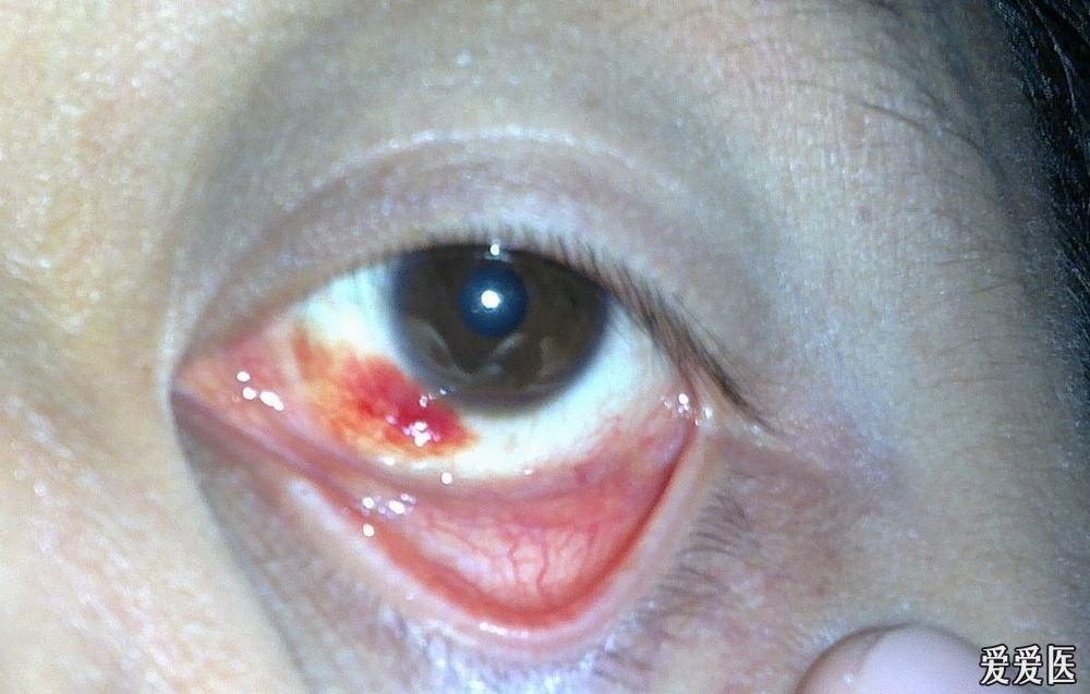 左眼球区域充血