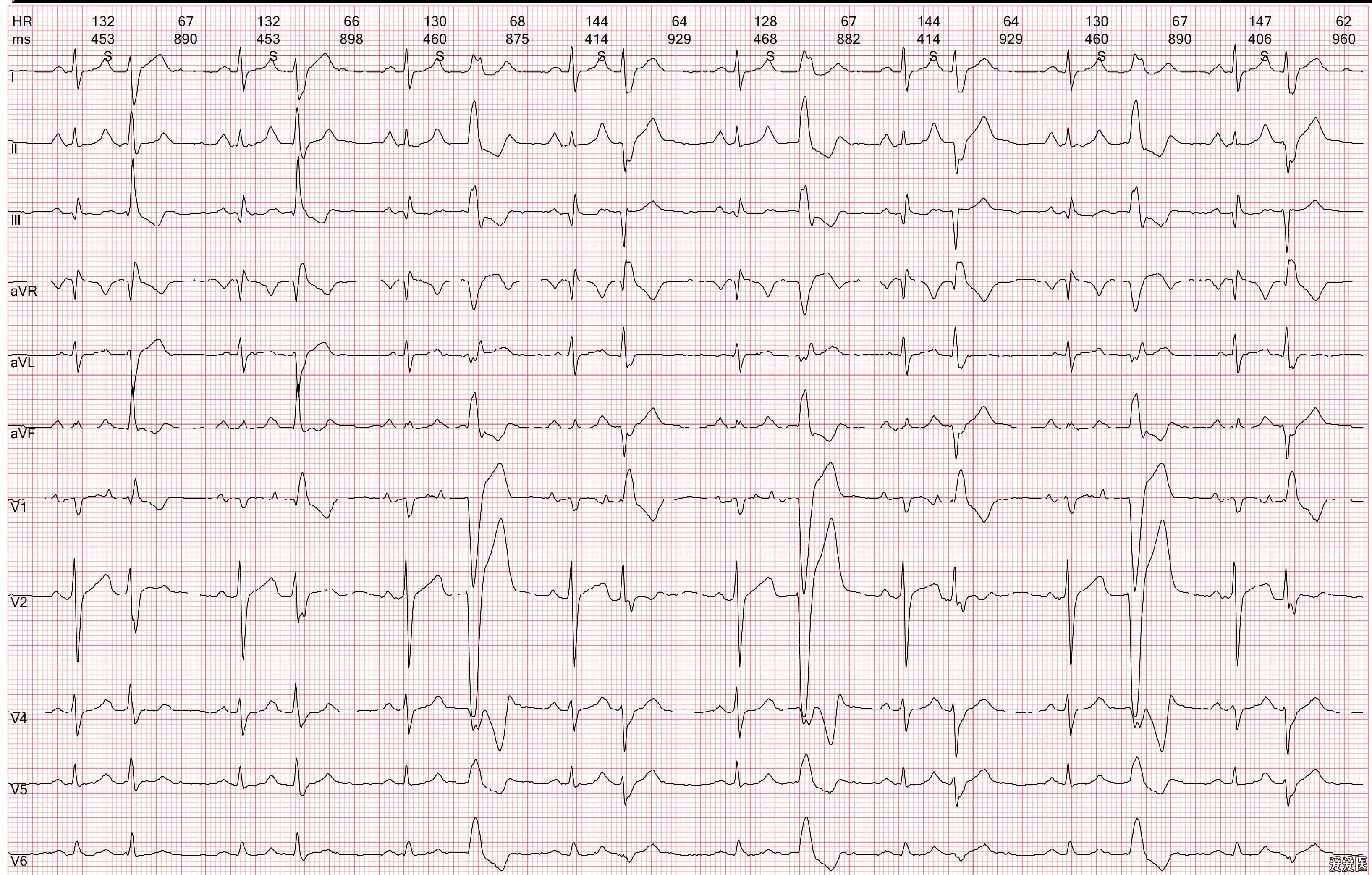 早搏的心电图波形图片