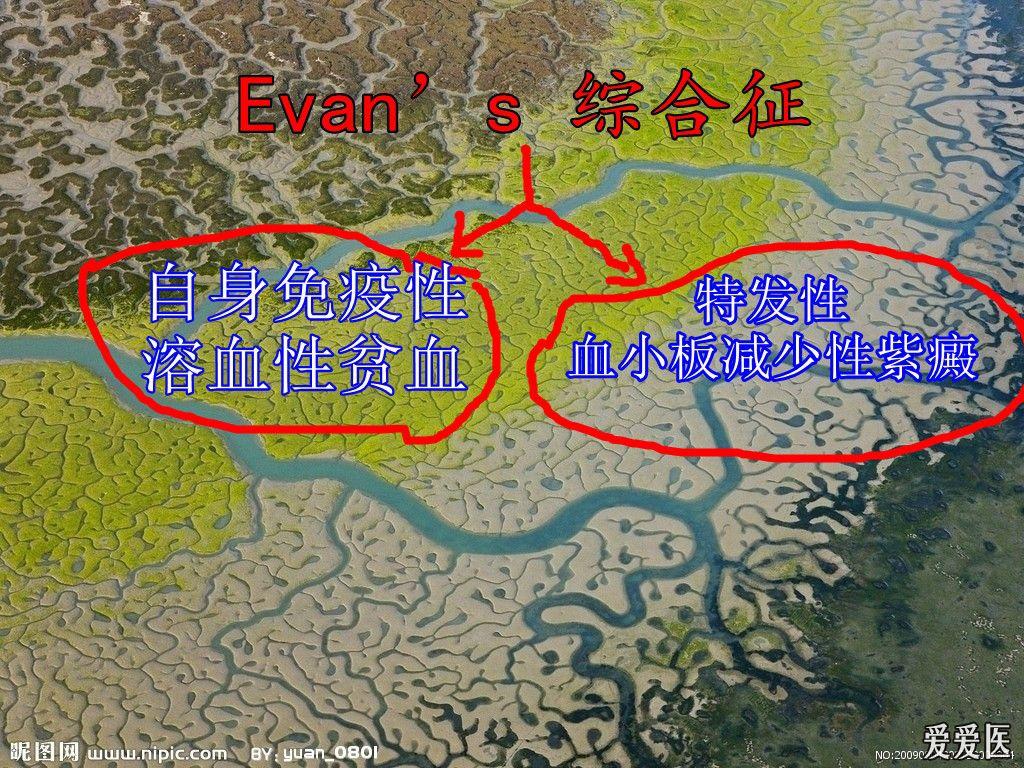 2011-10-27 22:38 编辑   借助这个病例,跟大家阐述一下 evanss 综合