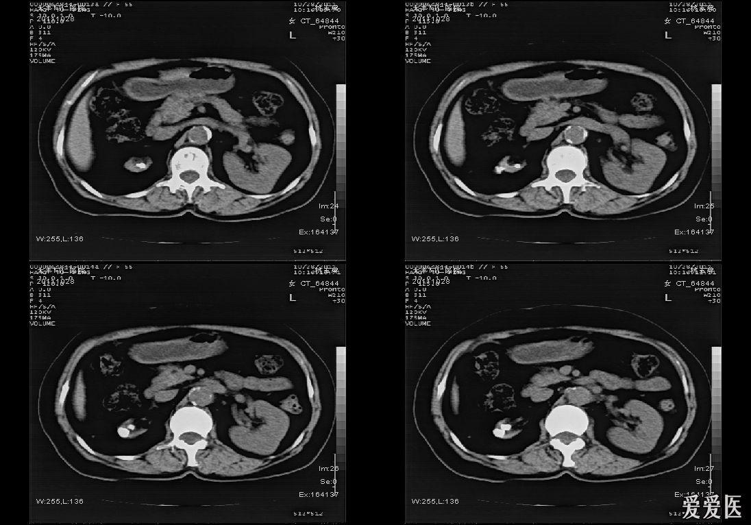 分享一例肾自截病例ct平扫