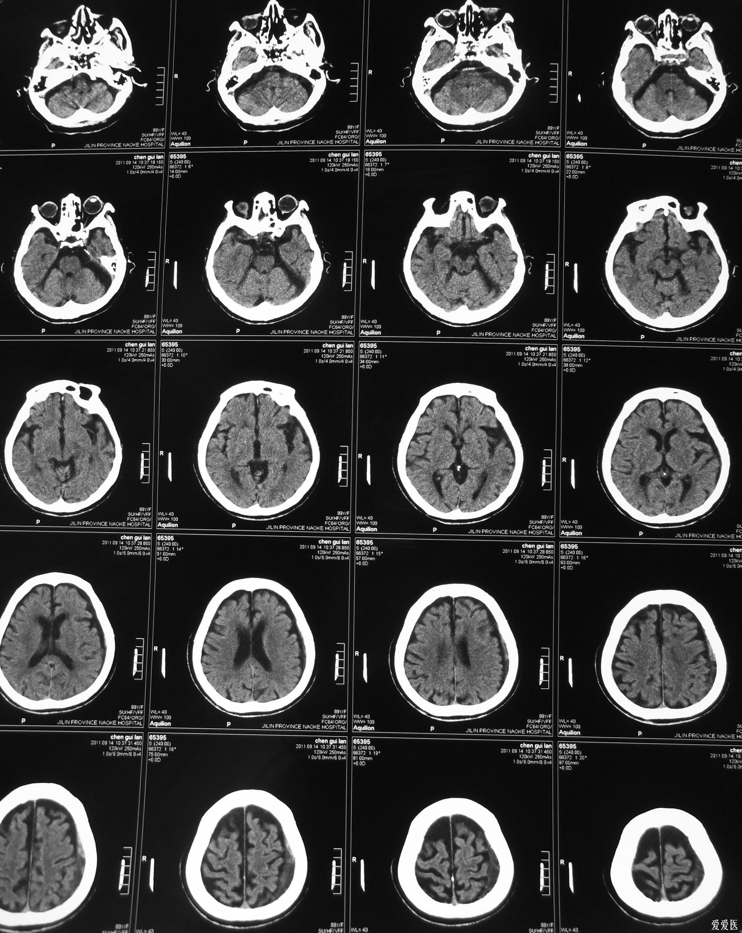 女患89歲陣發性tia發作(頭部ct mri)