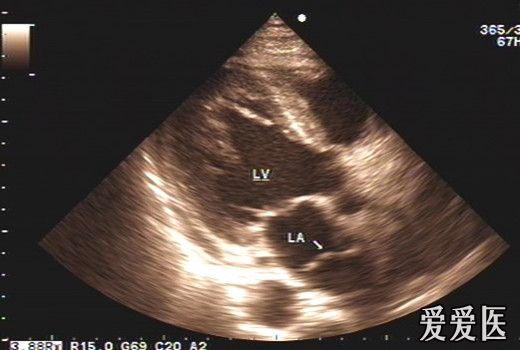 48岁先心病,考虑三房心 超声医学讨论版 爱爱医医学论坛