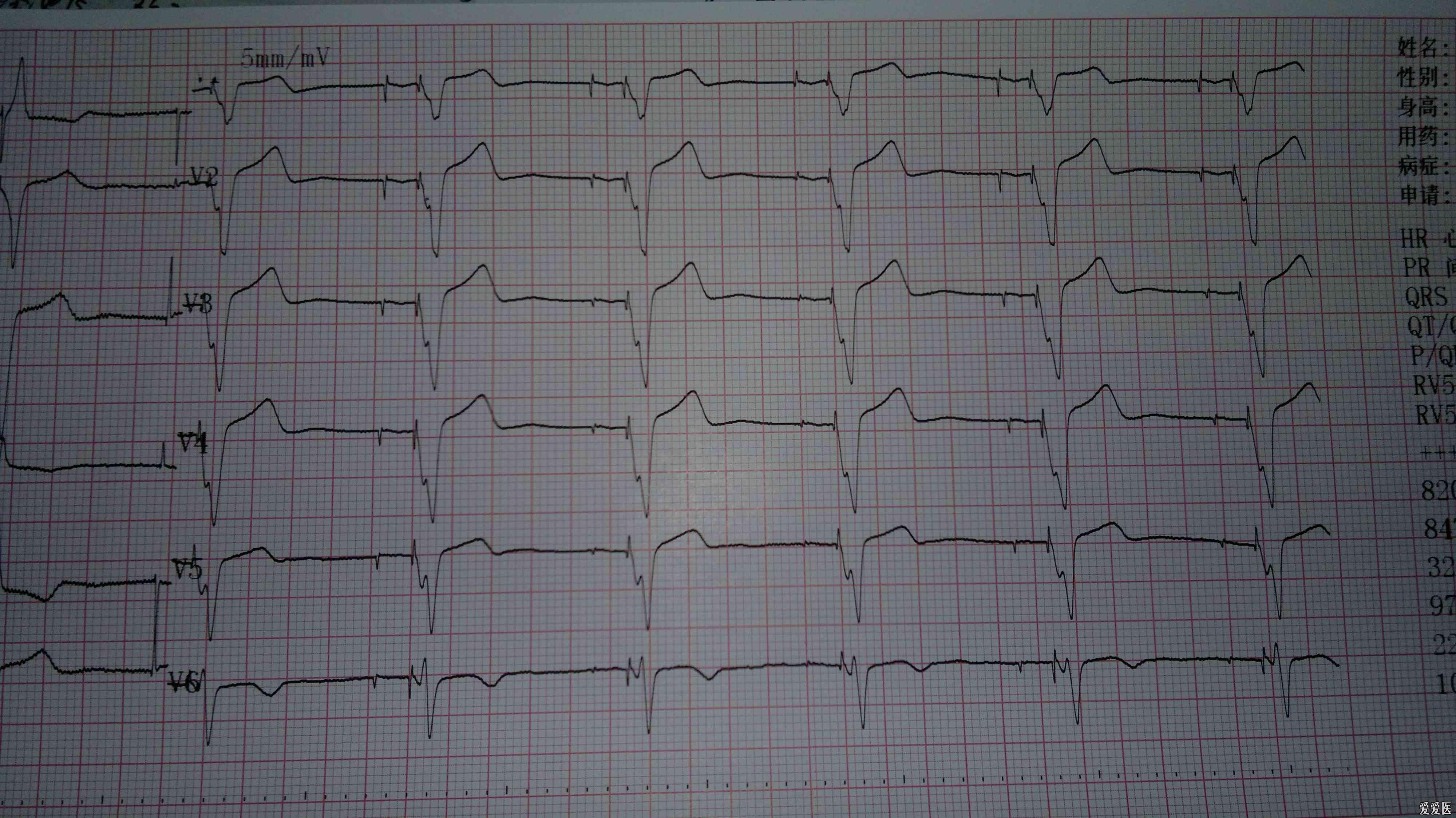 裝過起搏器的心電圖