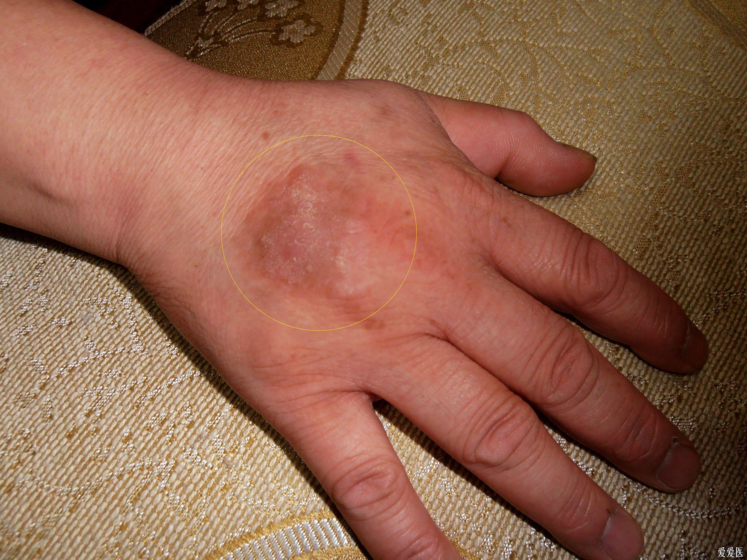 手背部的慢性湿疹求治疗 